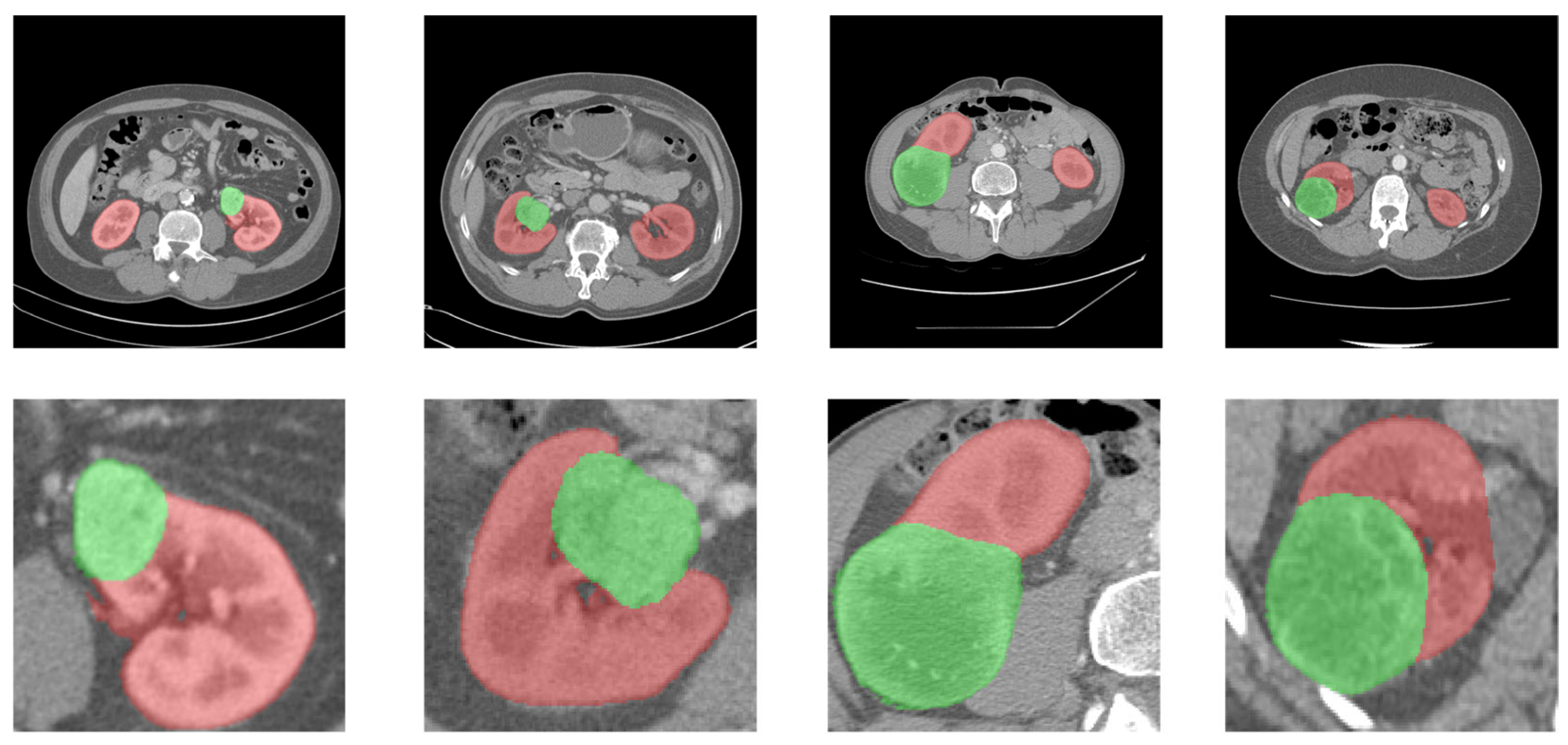 MDA-Net: A Segmentation Network for Kidney Tumor Based on Enhanced ...