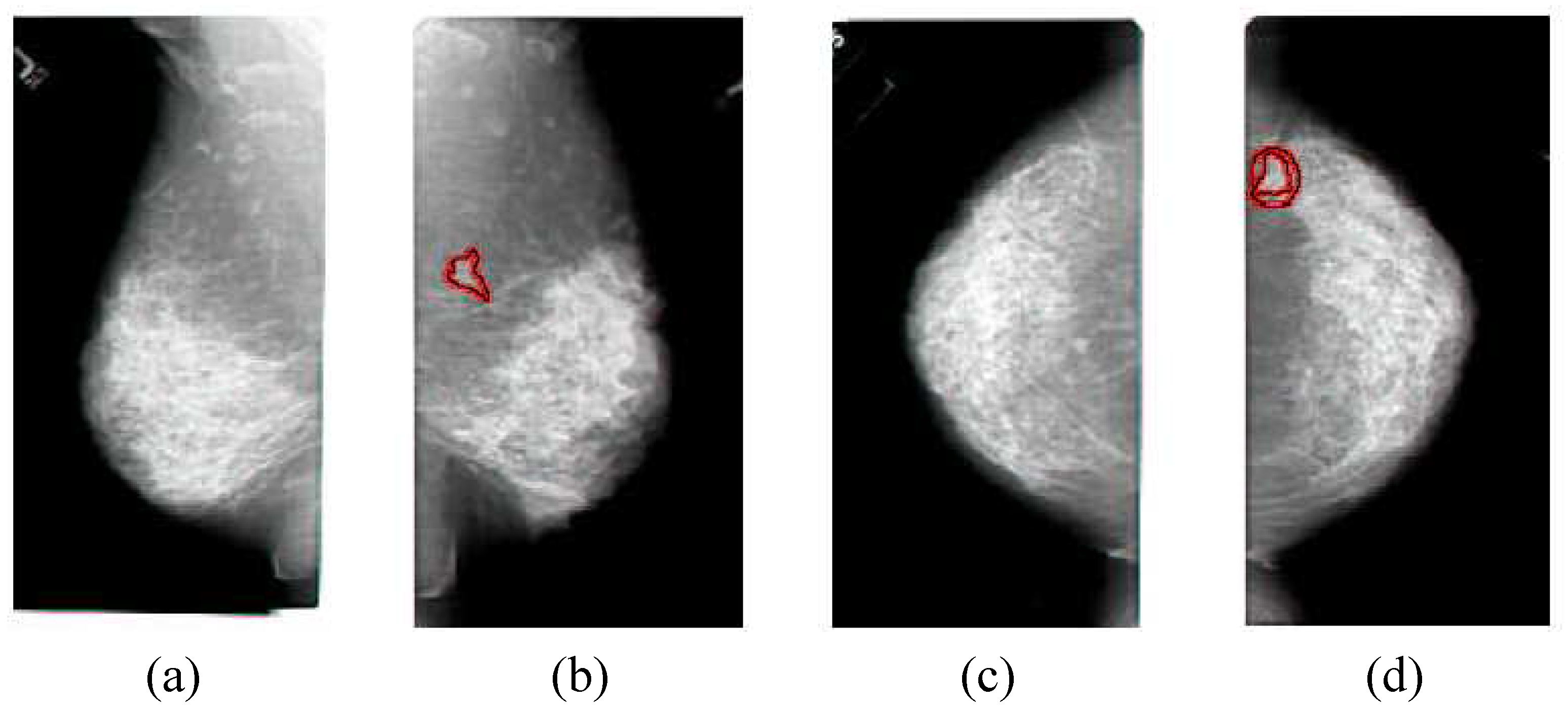 Comparison of the original breast mass images and their flipped images.