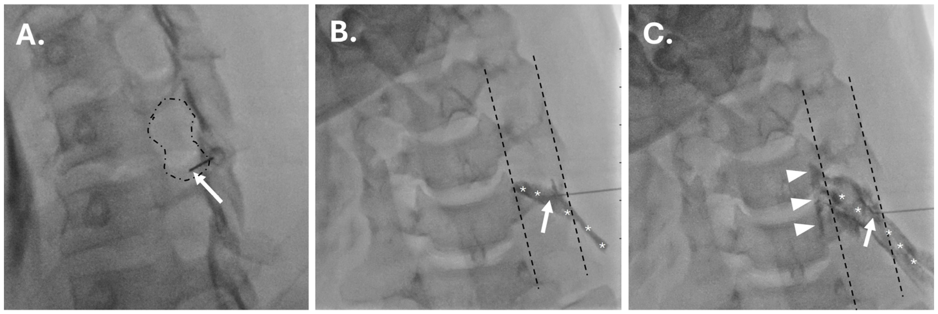 Nerve Root Injection Methods Safety of Perineural Lidocaine in Cervical Nerve Root Injections: A ...