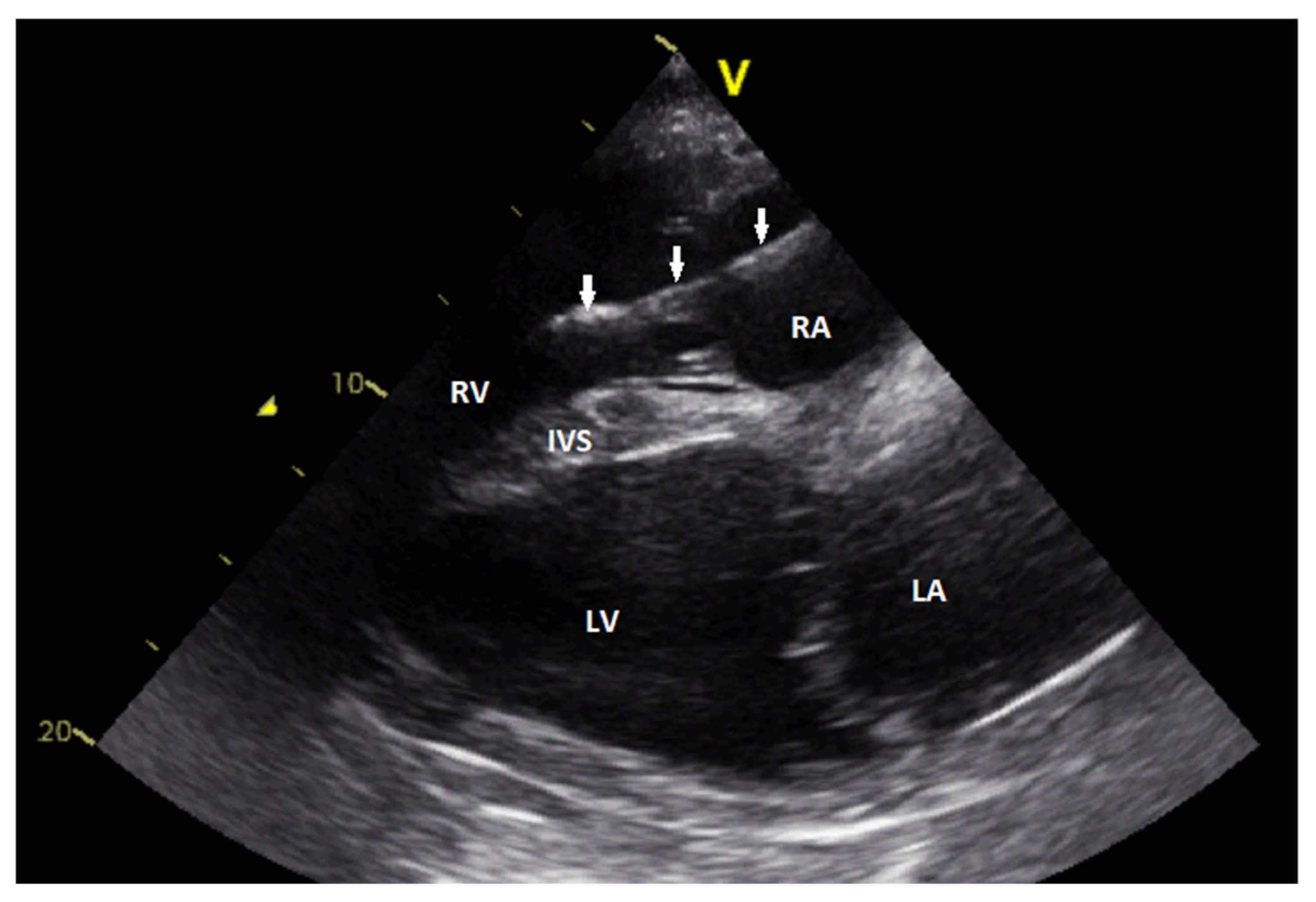 Single-Chamber Cardiac Pacemaker Implantation in a Donkey with Complete ...