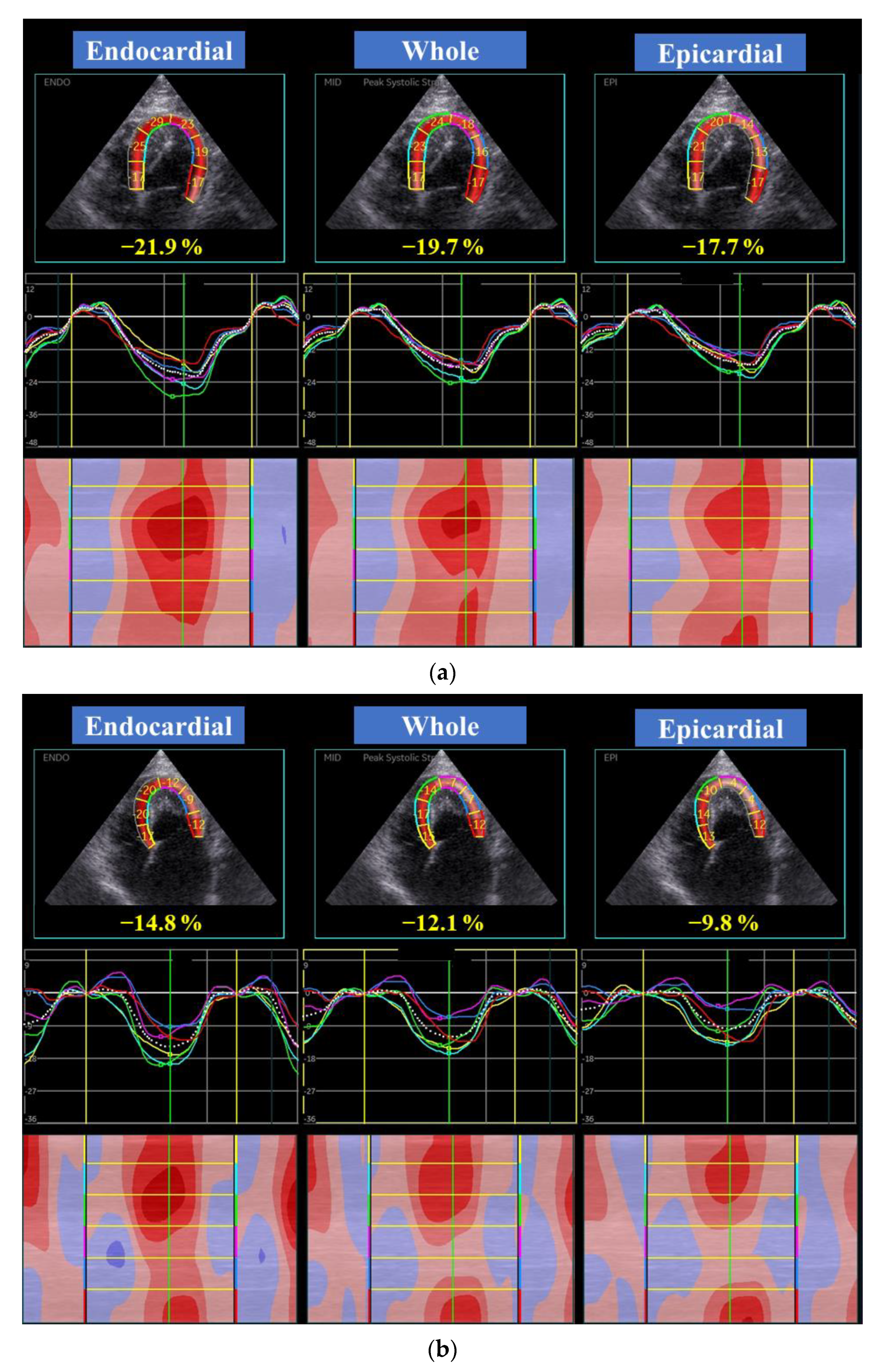 a Left ventricular global longitudinal strain curves of two