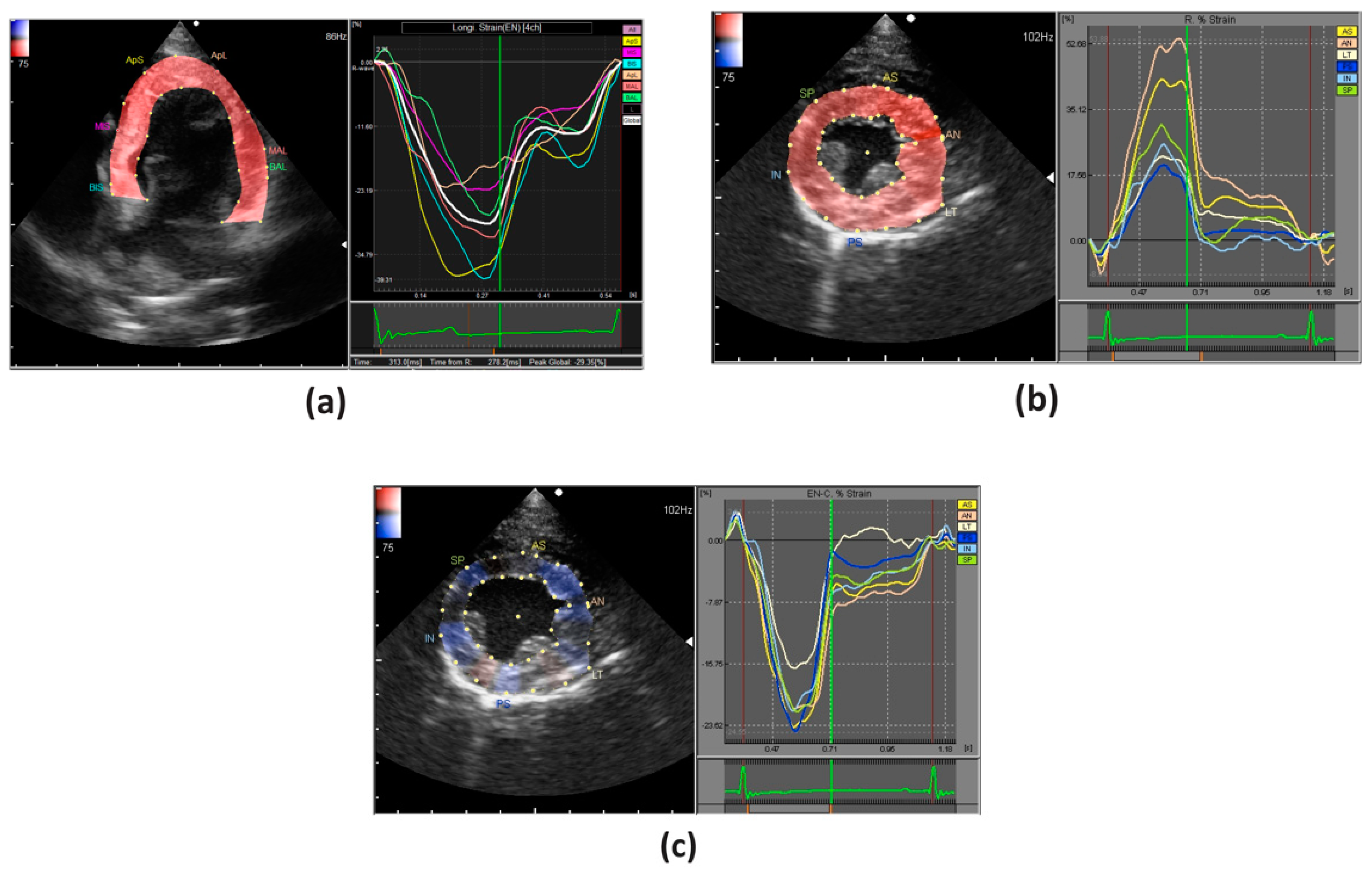Speckle Tracking Echocardiography: Early Predictor of Diagnosis