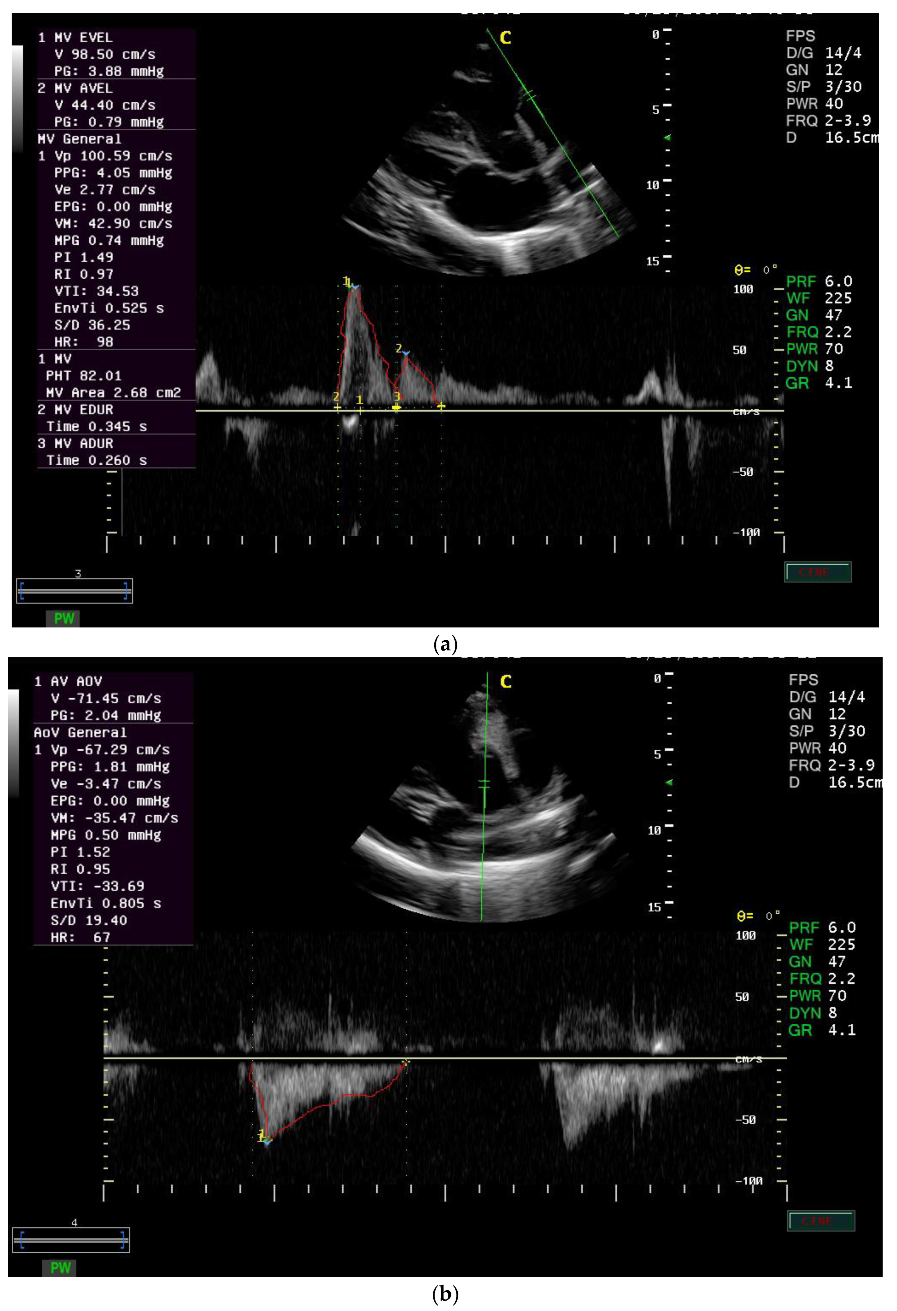 Animals | Free Full-Text | Reference Values and Repeatability of Pulsed  Wave Doppler Echocardiography Parameters in Normal Donkeys