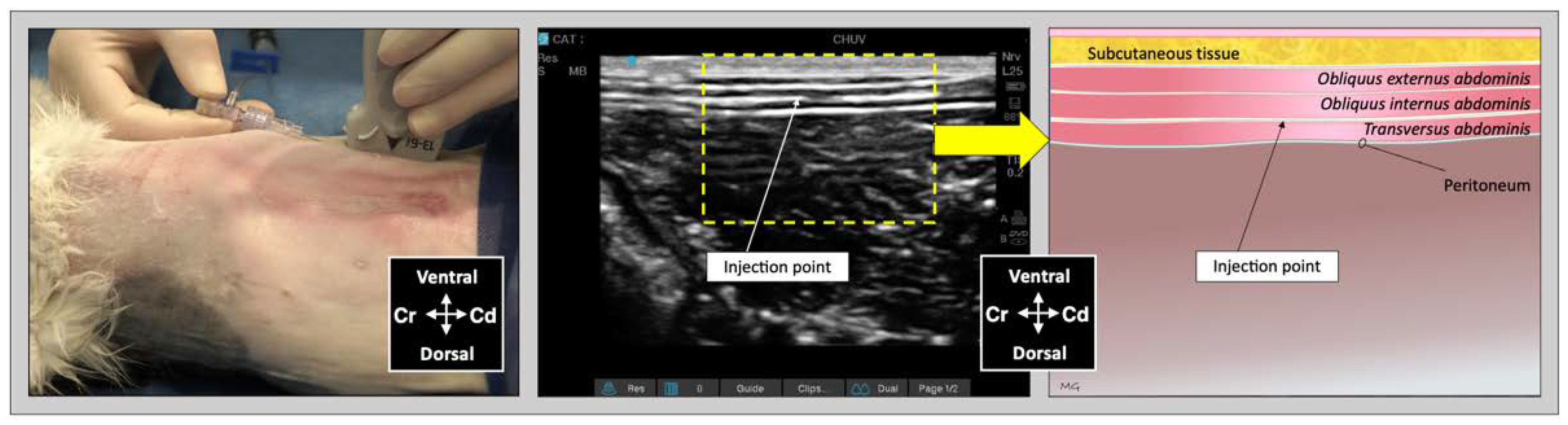 Frontiers  Ultrasound-guided transversus abdominis plane block as