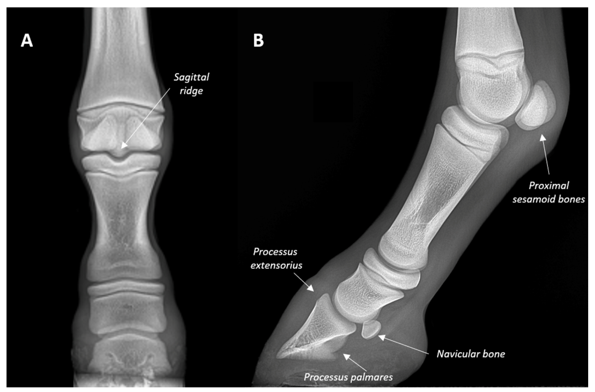 Frontiers | Efficacy of modified kidner procedure combined with subtalar  arthroereisis treating adolescent type 2 painful accessory navicular with  flexible flatfoot