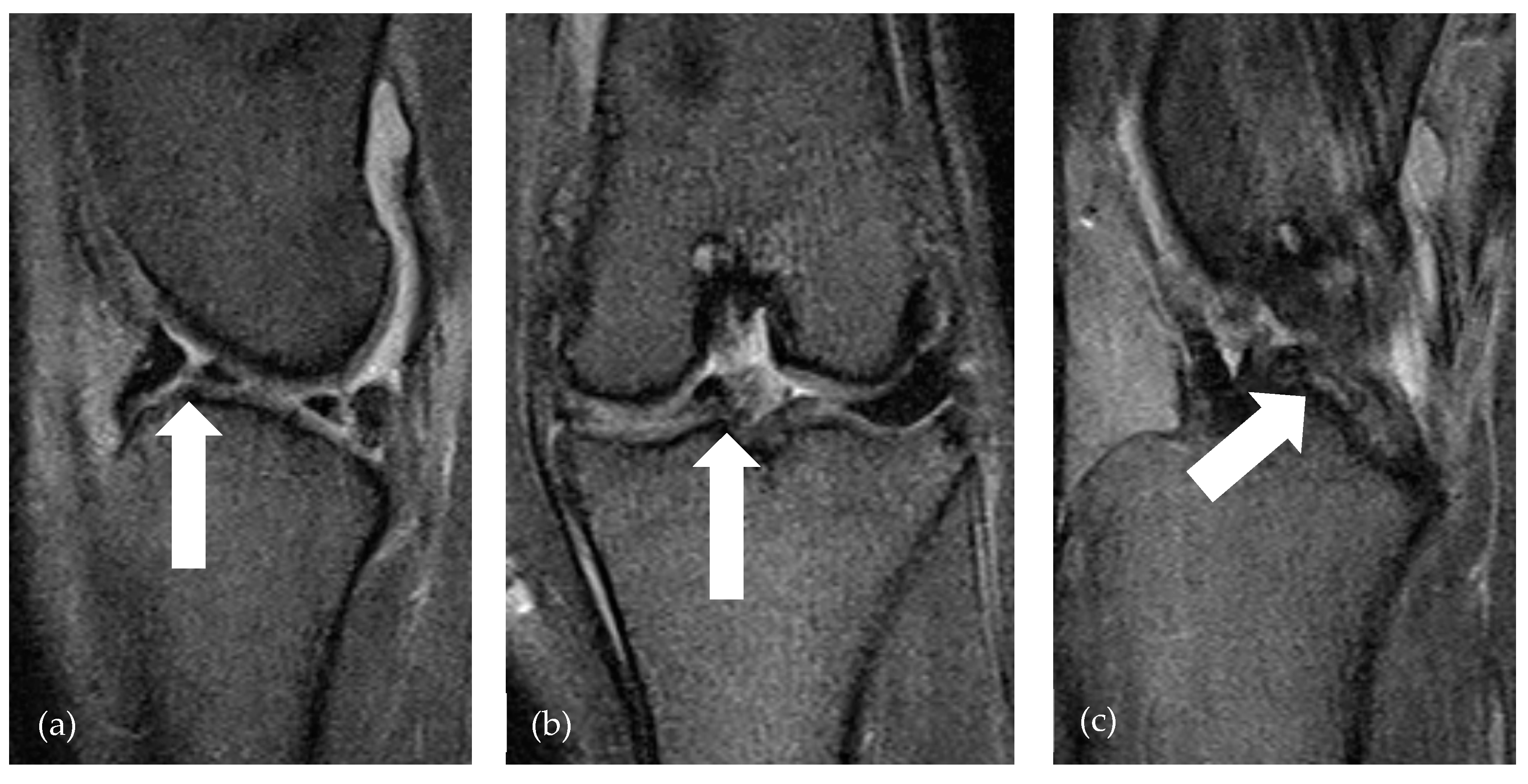 Low-Field Magnetic Resonance Imaging for the Detection of Medial ...