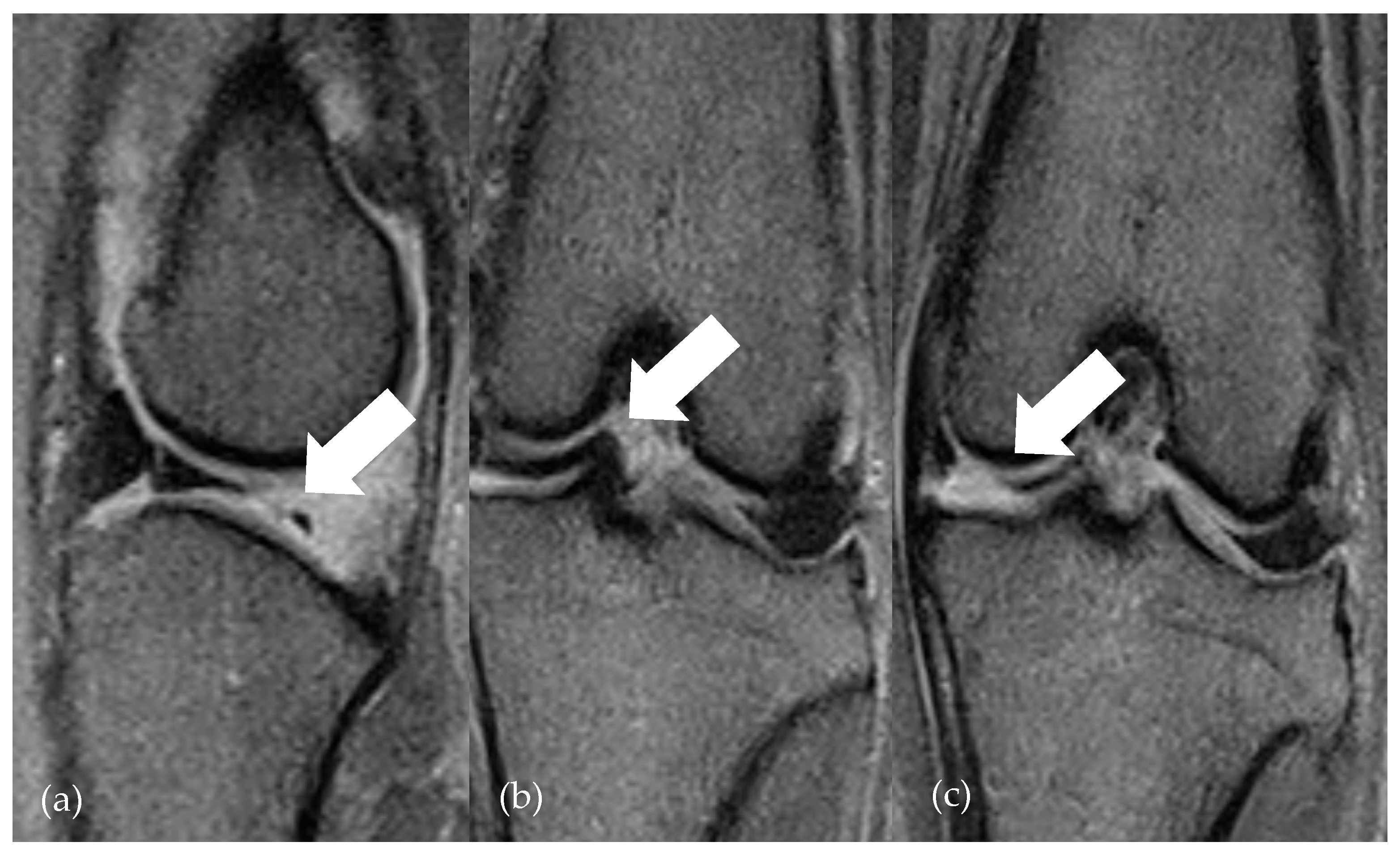 Low-Field Magnetic Resonance Imaging for the Detection of Medial ...