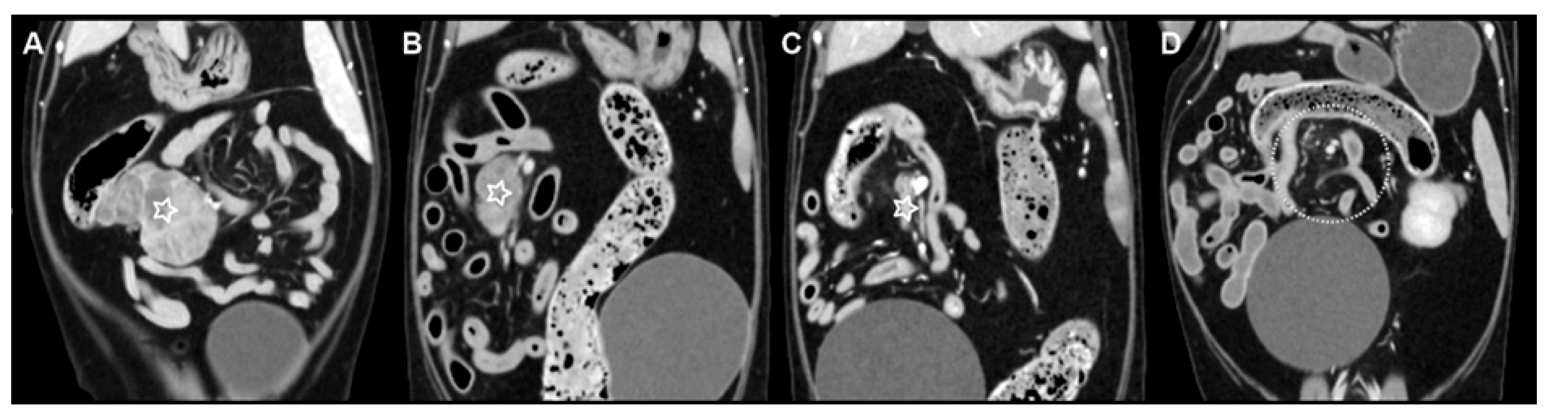 Multicentric Round Cell Neoplasia with Plasmacytic Differentiation in a ...