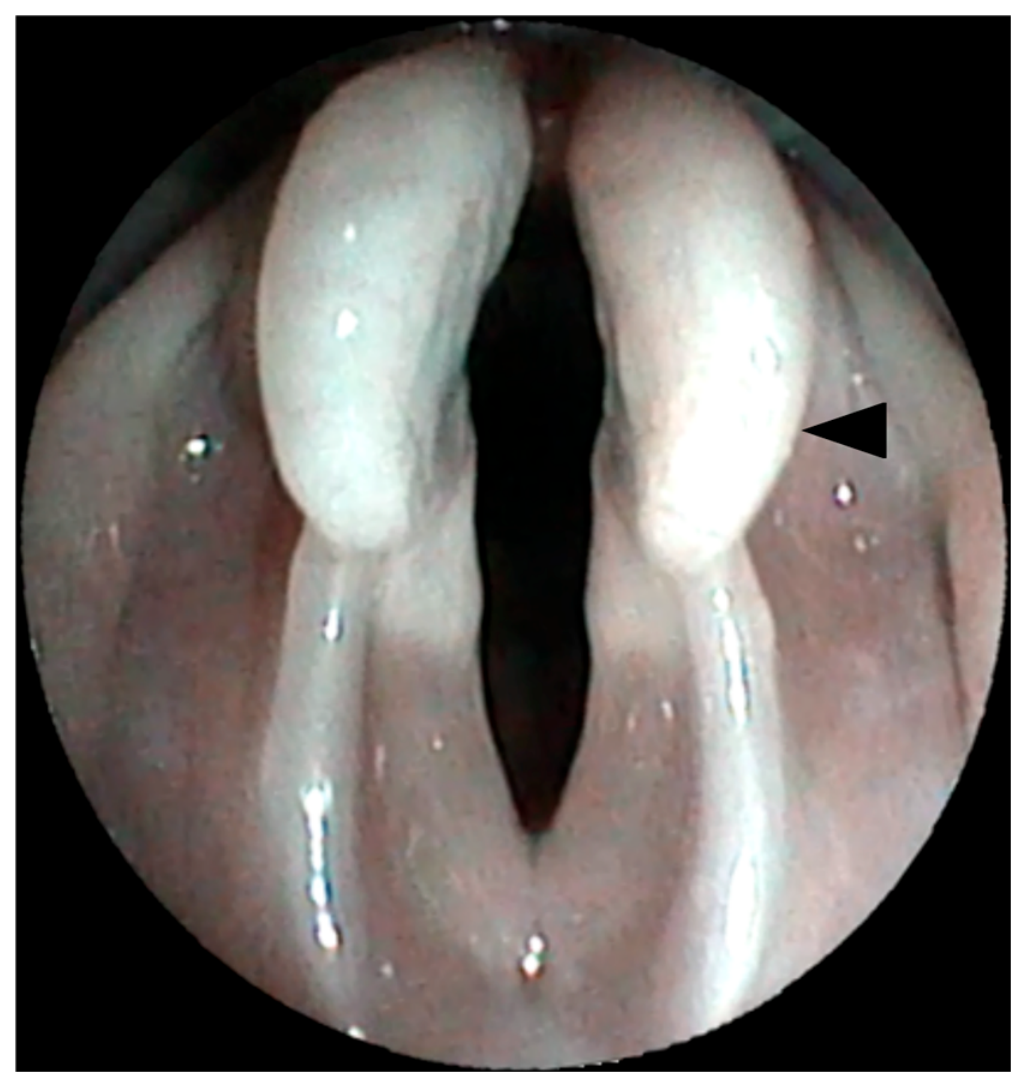 Transoral Endoscopic-Assisted Partial Arytenoidectomy as a Treatment ...