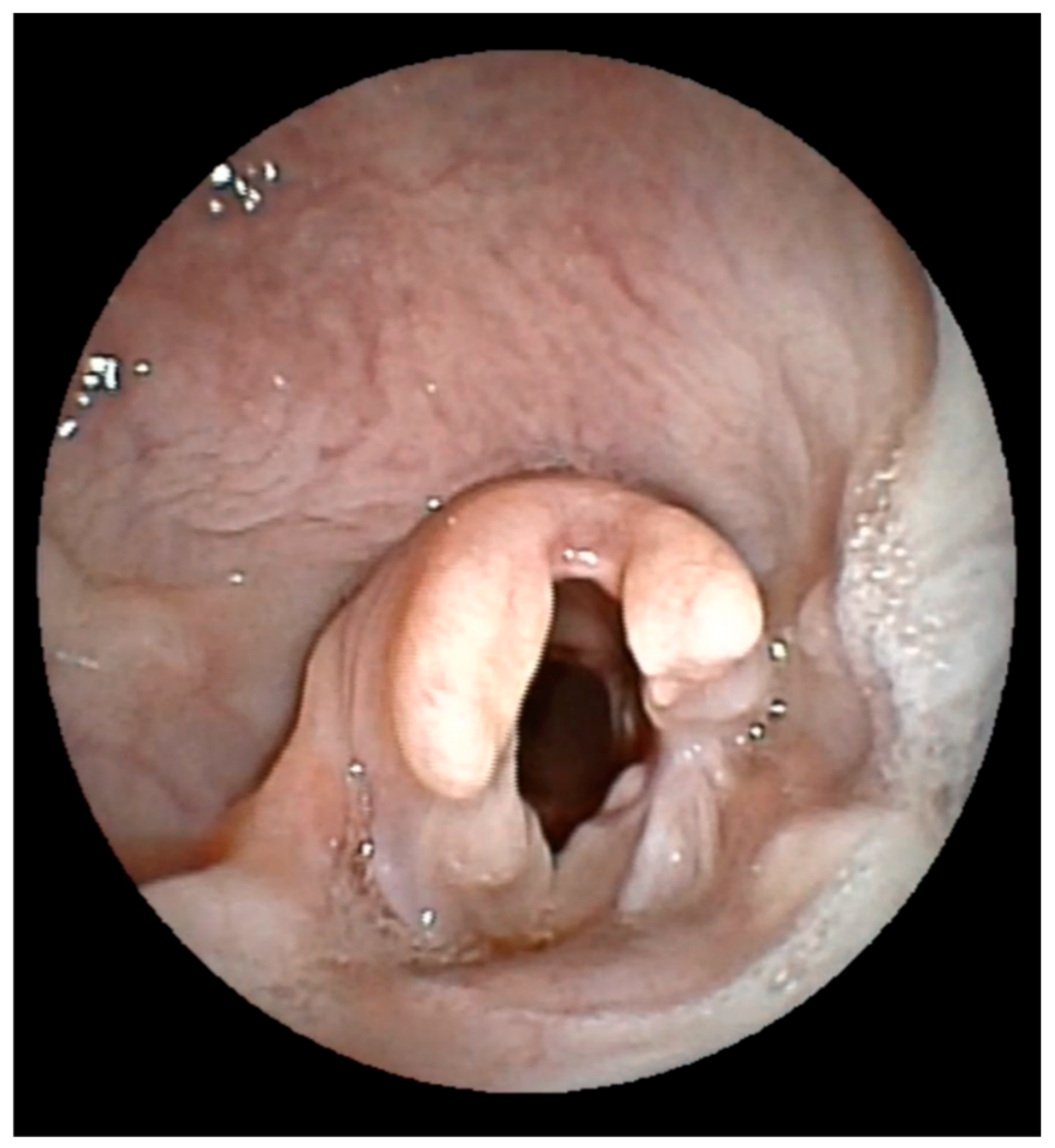 Transoral Endoscopic-Assisted Partial Arytenoidectomy as a Treatment ...