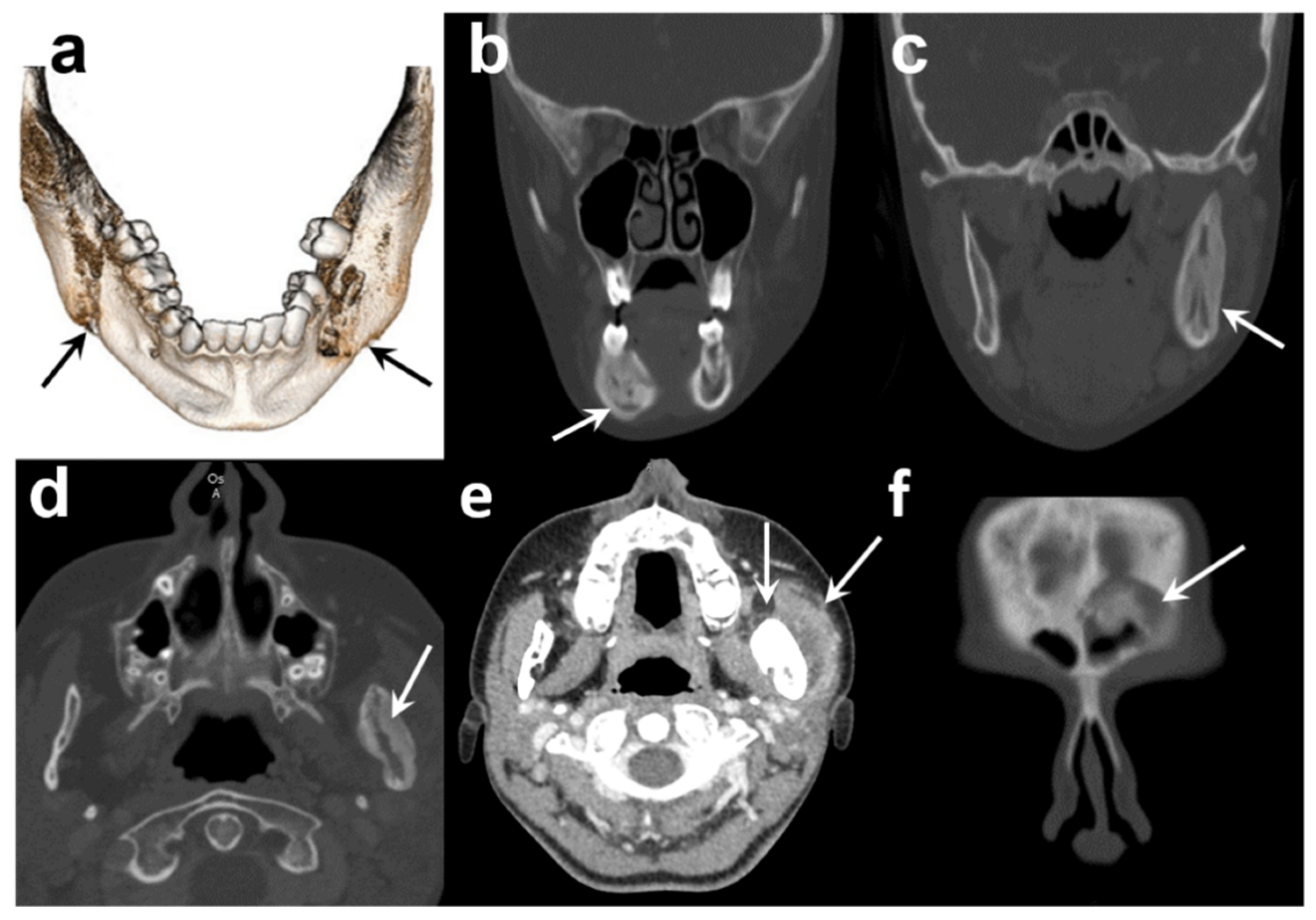 osteomyelitis x ray jaw