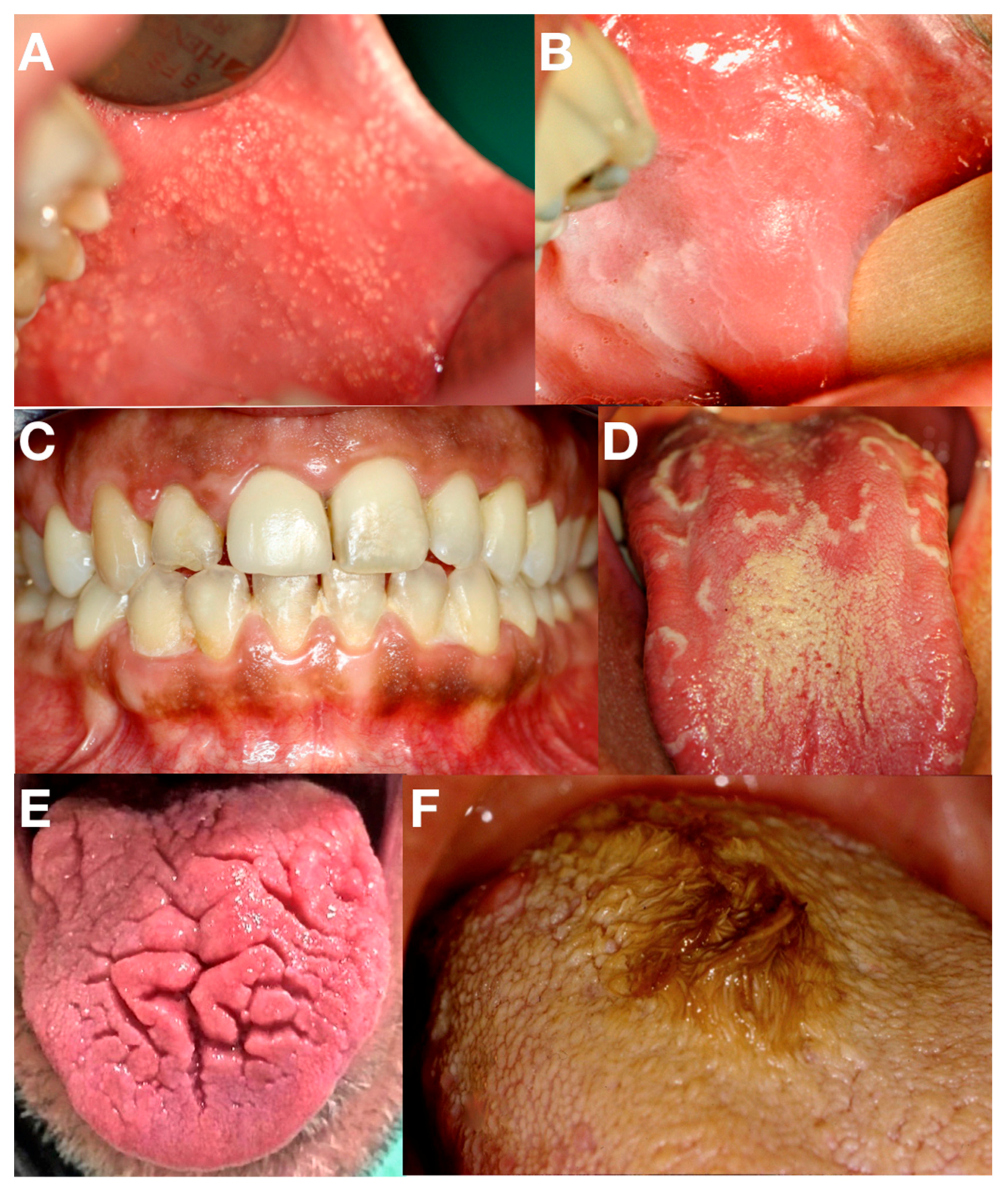 Oral exam: damage caused by lip sucking | Registered Dental Hygienists