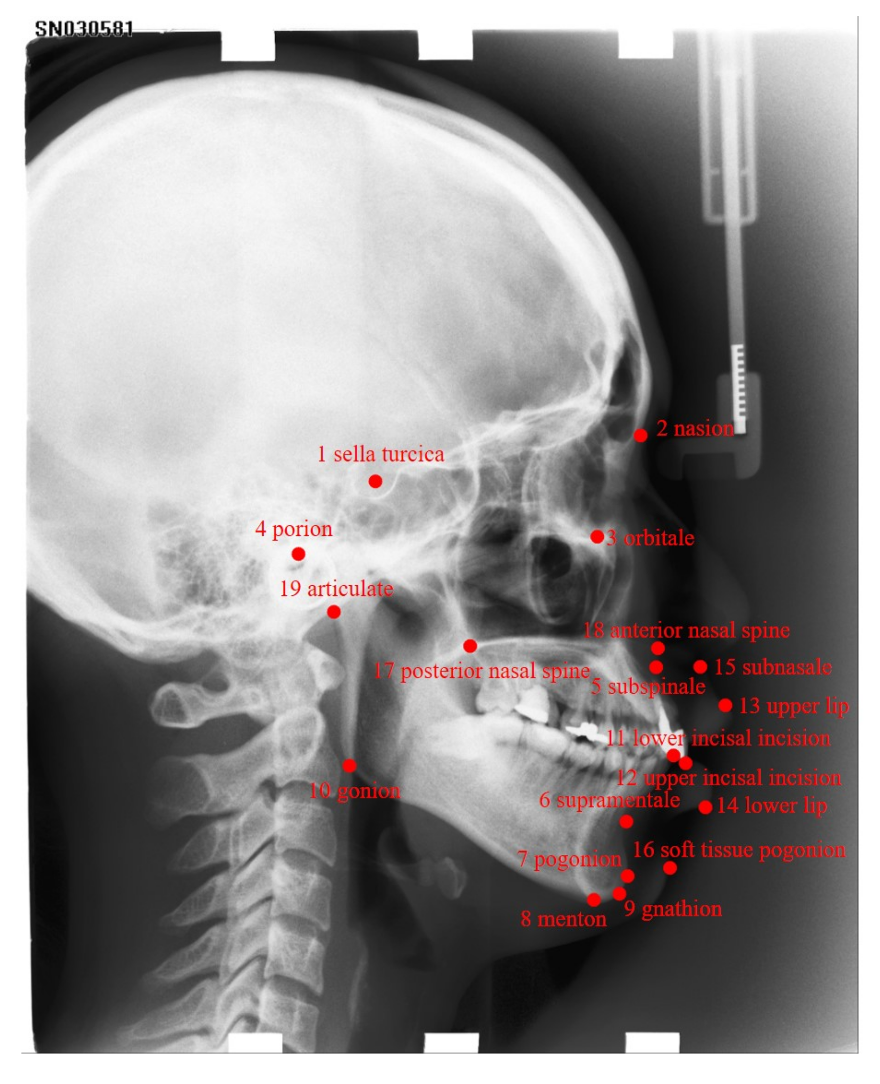 Automatic Cephalometric Landmark Detection On X ray Images Using A Deep Automatic Cephalometric Landmark Detection On X ray Images Using A Deep
