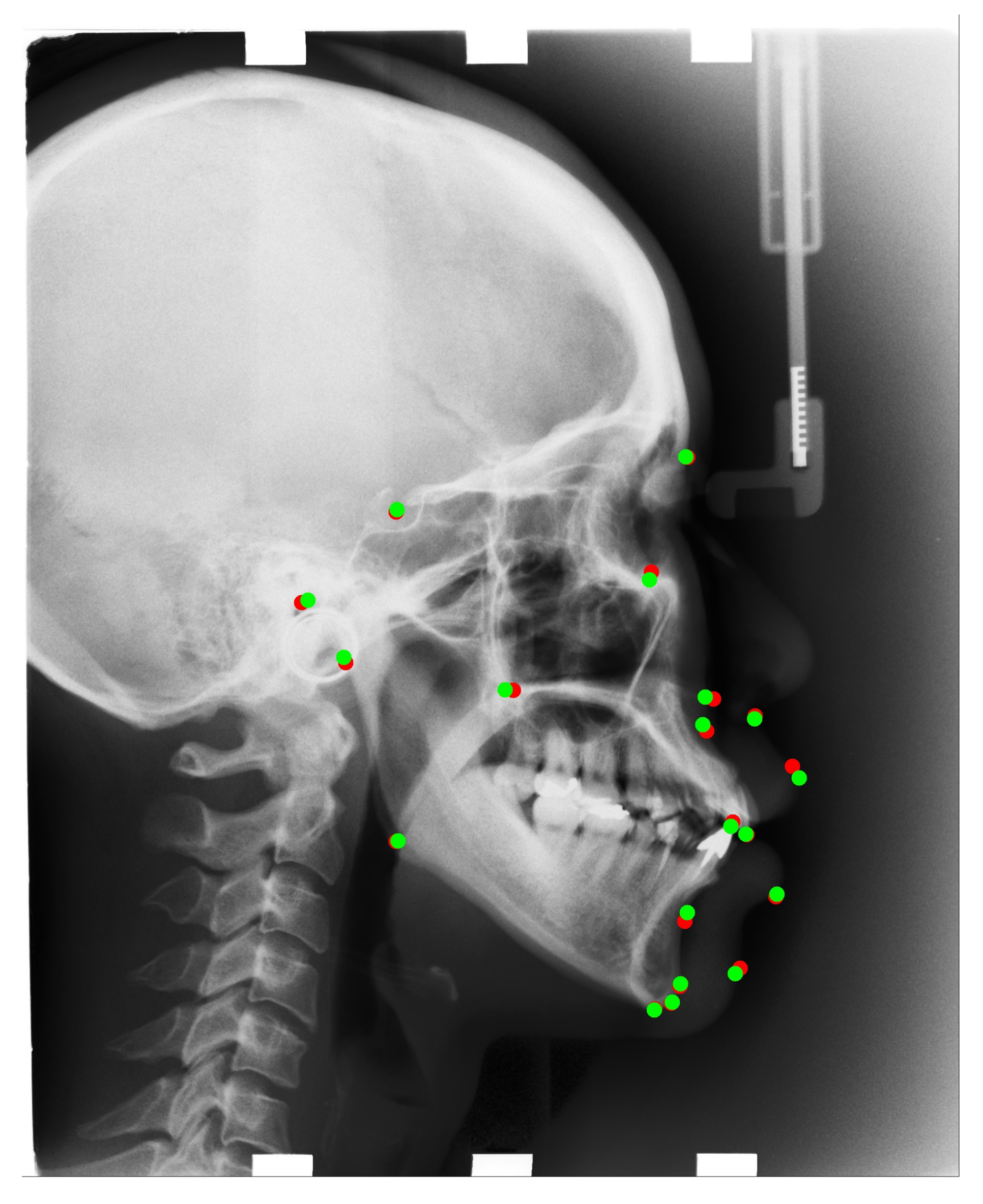 Automatic Cephalometric Landmark Detection On X ray Images Using A Deep Automatic Cephalometric Landmark Detection On X ray Images Using A Deep