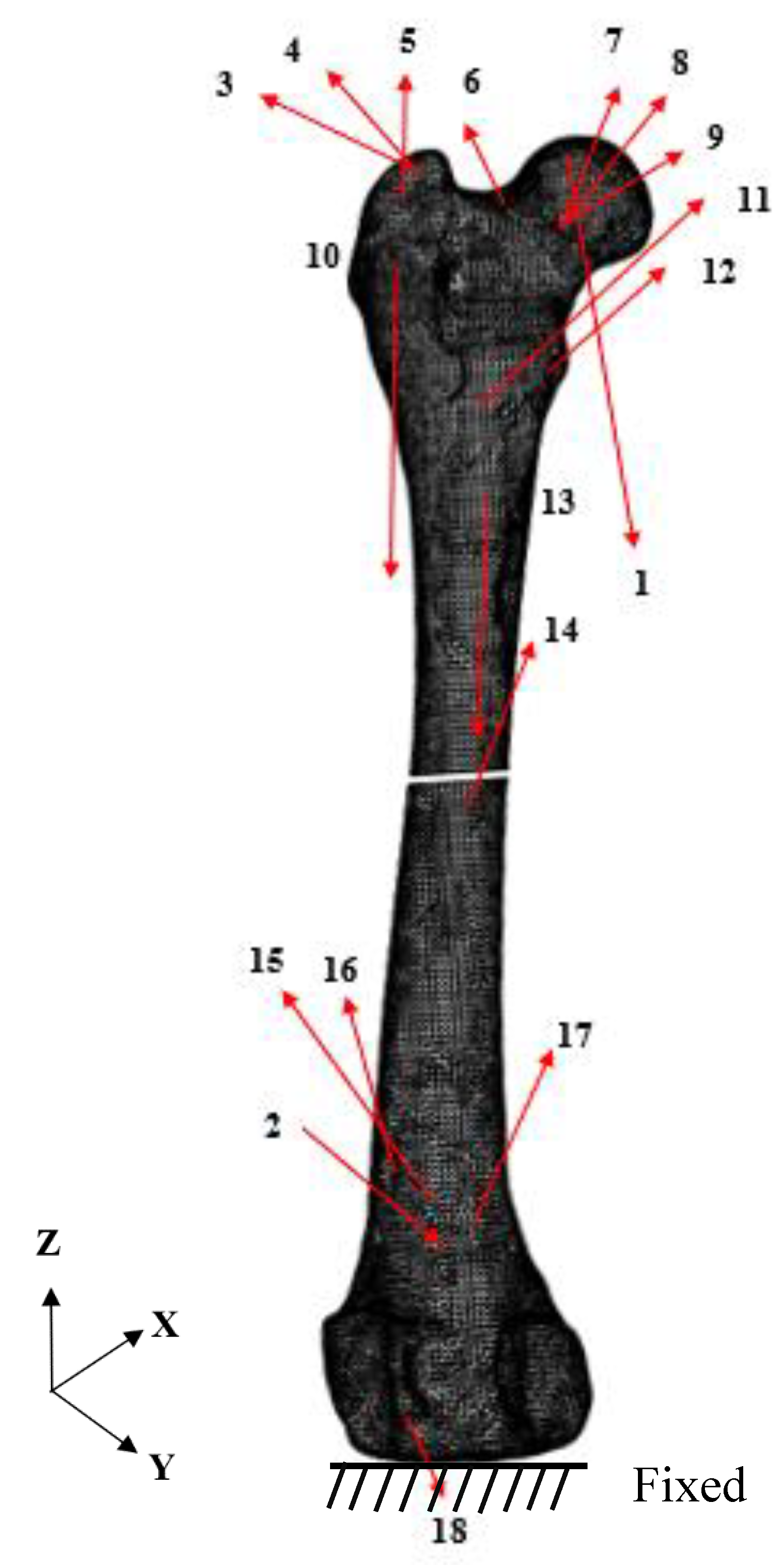Interlocking Nail Fixation of an Opening Wedge Corrective Osteotomy for  Femoral Malunion in a Dog