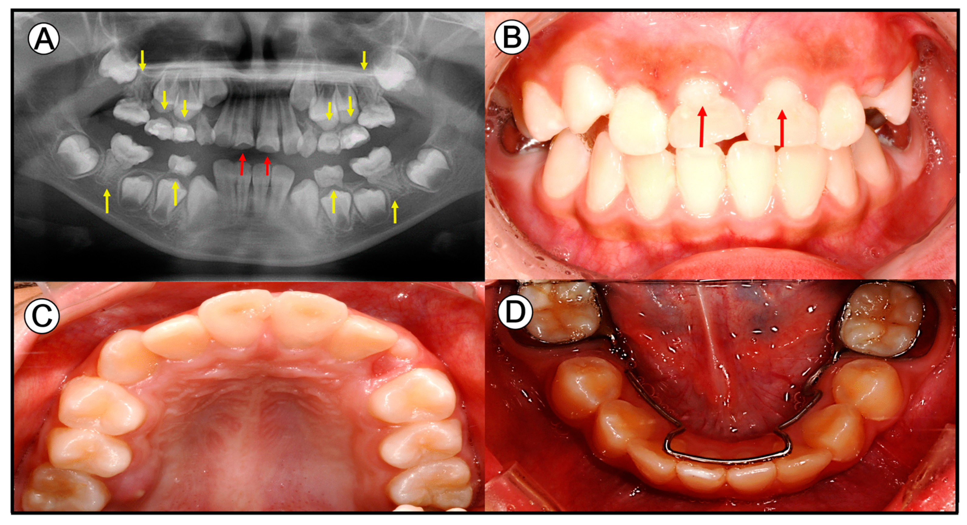 Comparison of dental anomalies between the groups with impacted