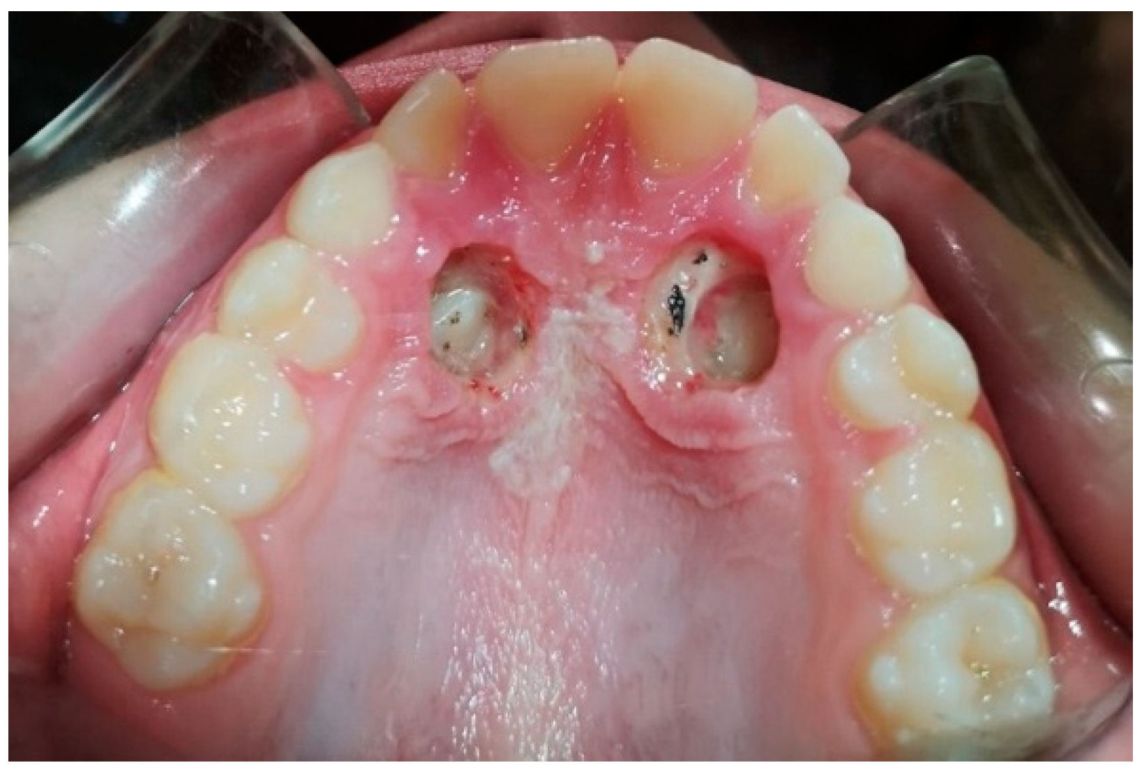 Applied Sciences Free FullText Disinclusion of Palatally Impacted