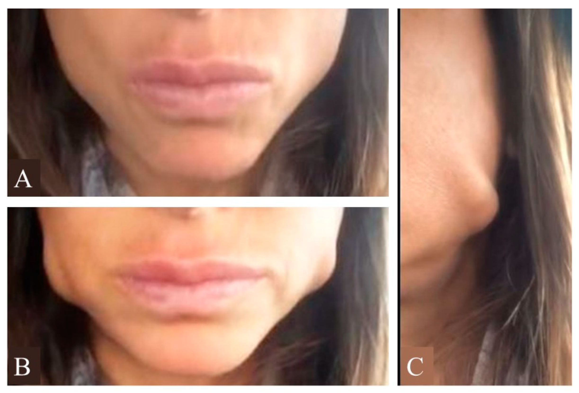 Biphasic Injection For Masseter Muscle Reduction With Botulinum Toxin Biphasic Injection For Masseter Muscle Reduction With Botulinum Toxin