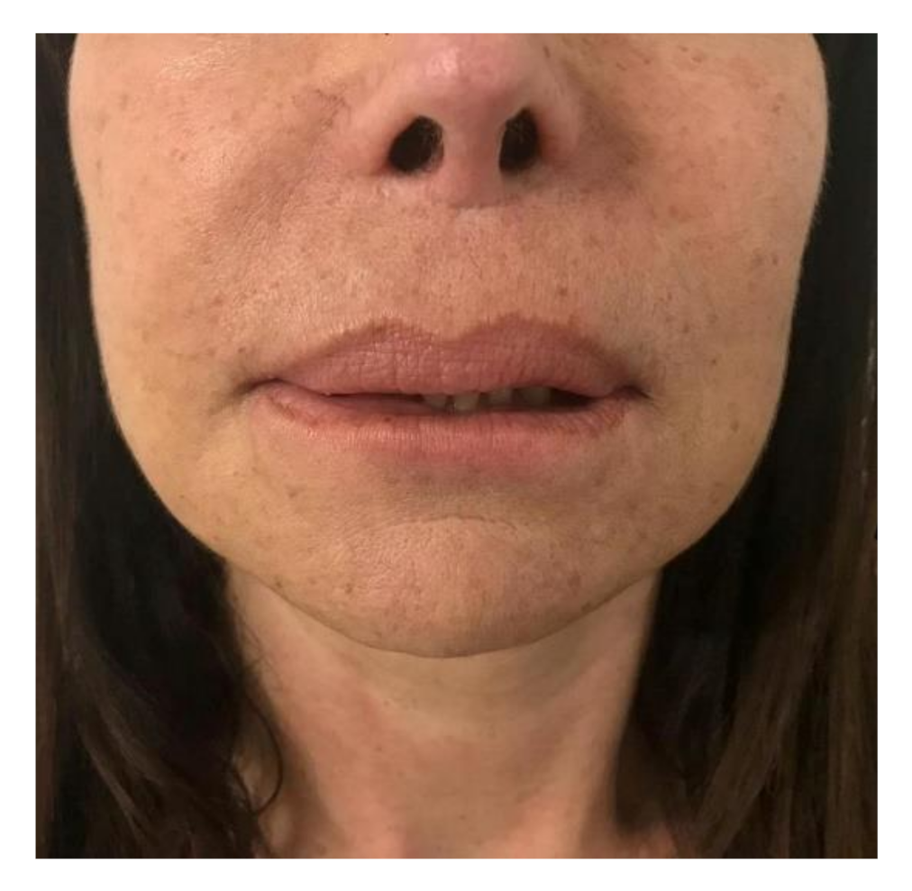 Lip Filler After Care - The Oxford Smile Clinics