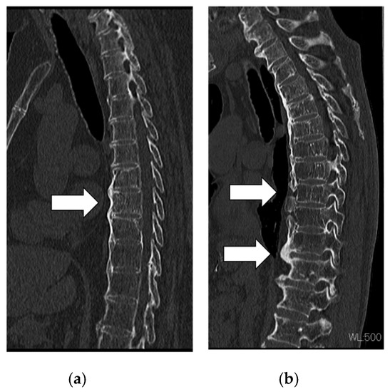 Biomechanical Analysis of the Spine in Diffuse Idiopathic Skeletal ...