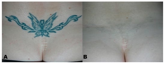 Laser Tattoo Removal Before and After TattooRemovalClinic