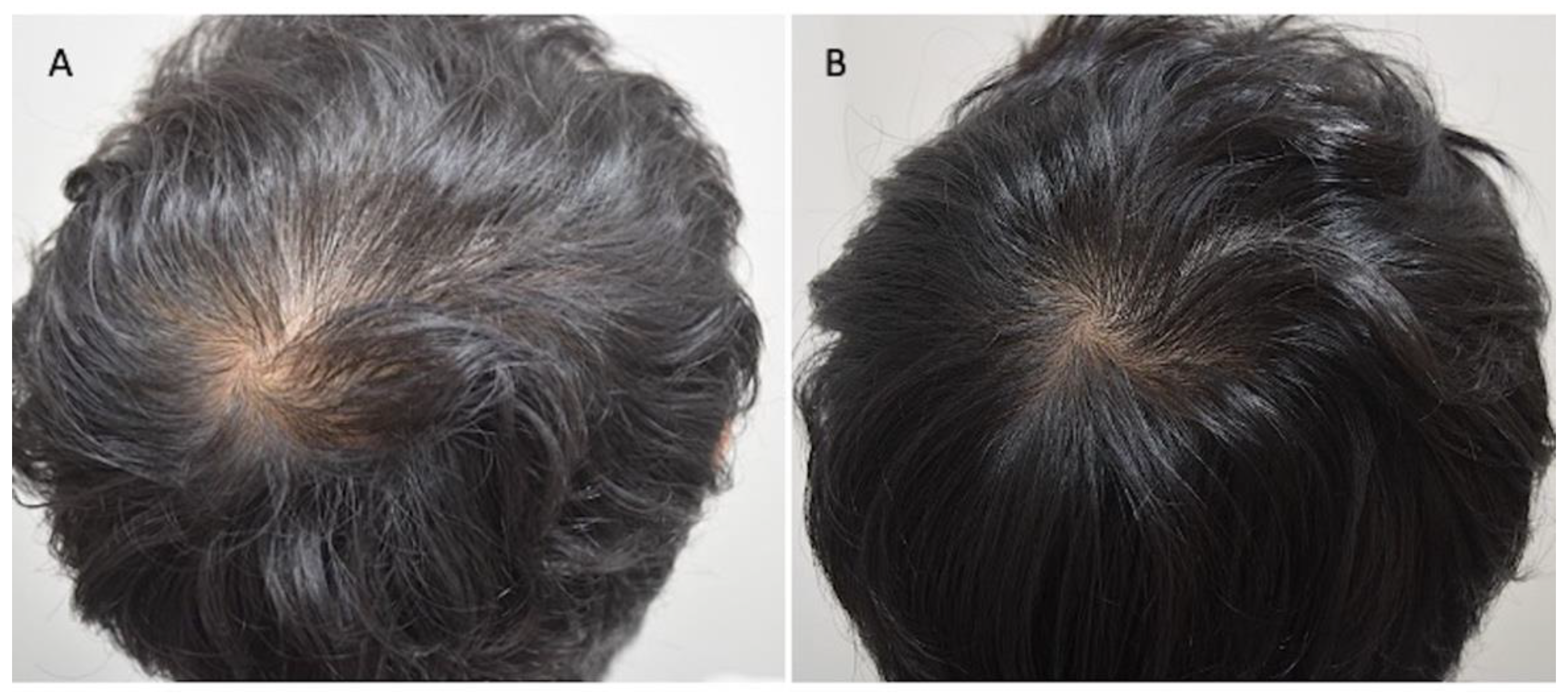 Applied Sciences | Free Full-Text | Regenerative Biotechnologies in Plastic  Surgery: A Multicentric, Retrospective, Case-Series Study on the Use of  Micro-Needling with Low-Level Light/Laser Therapy as a Hair Growth Boost in  Patients