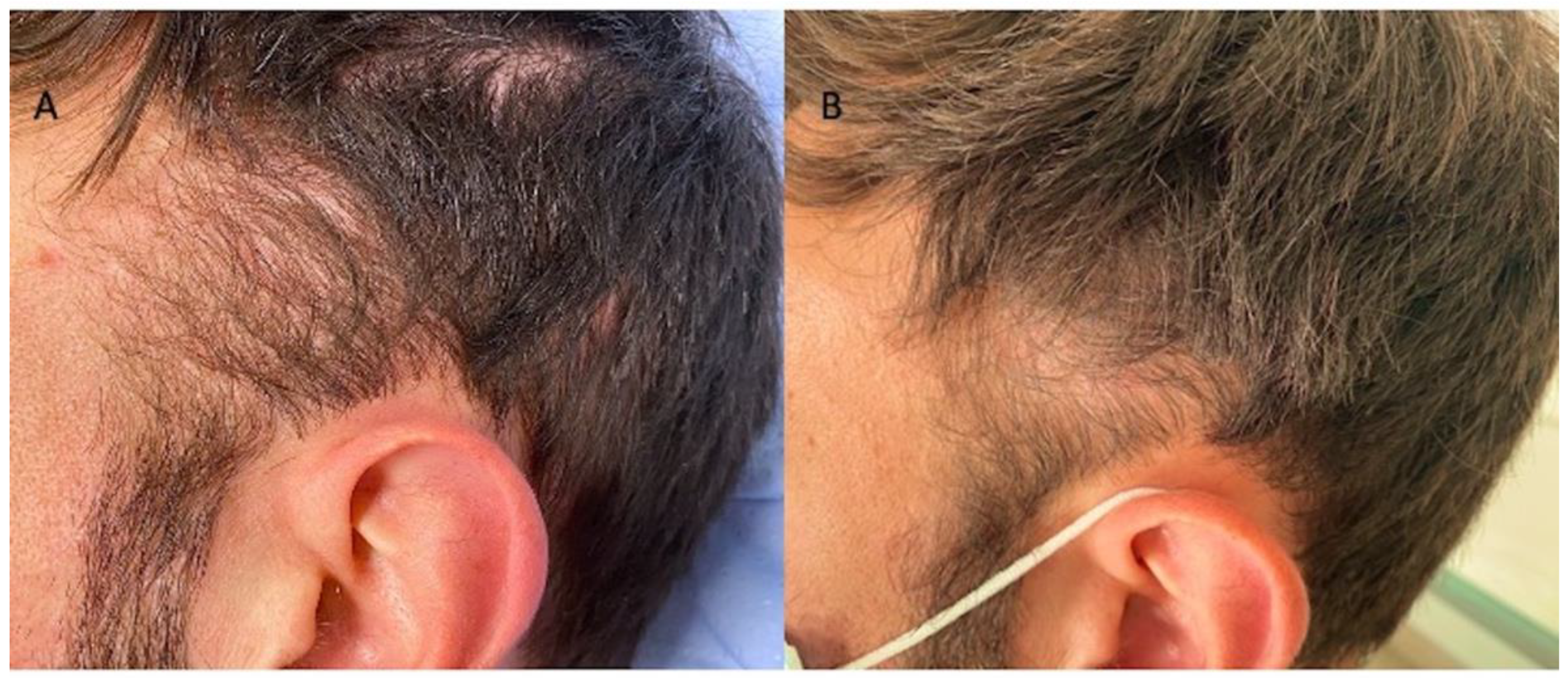 Applied Sciences | Free Full-Text | Regenerative Biotechnologies in Plastic  Surgery: A Multicentric, Retrospective, Case-Series Study on the Use of  Micro-Needling with Low-Level Light/Laser Therapy as a Hair Growth Boost in  Patients