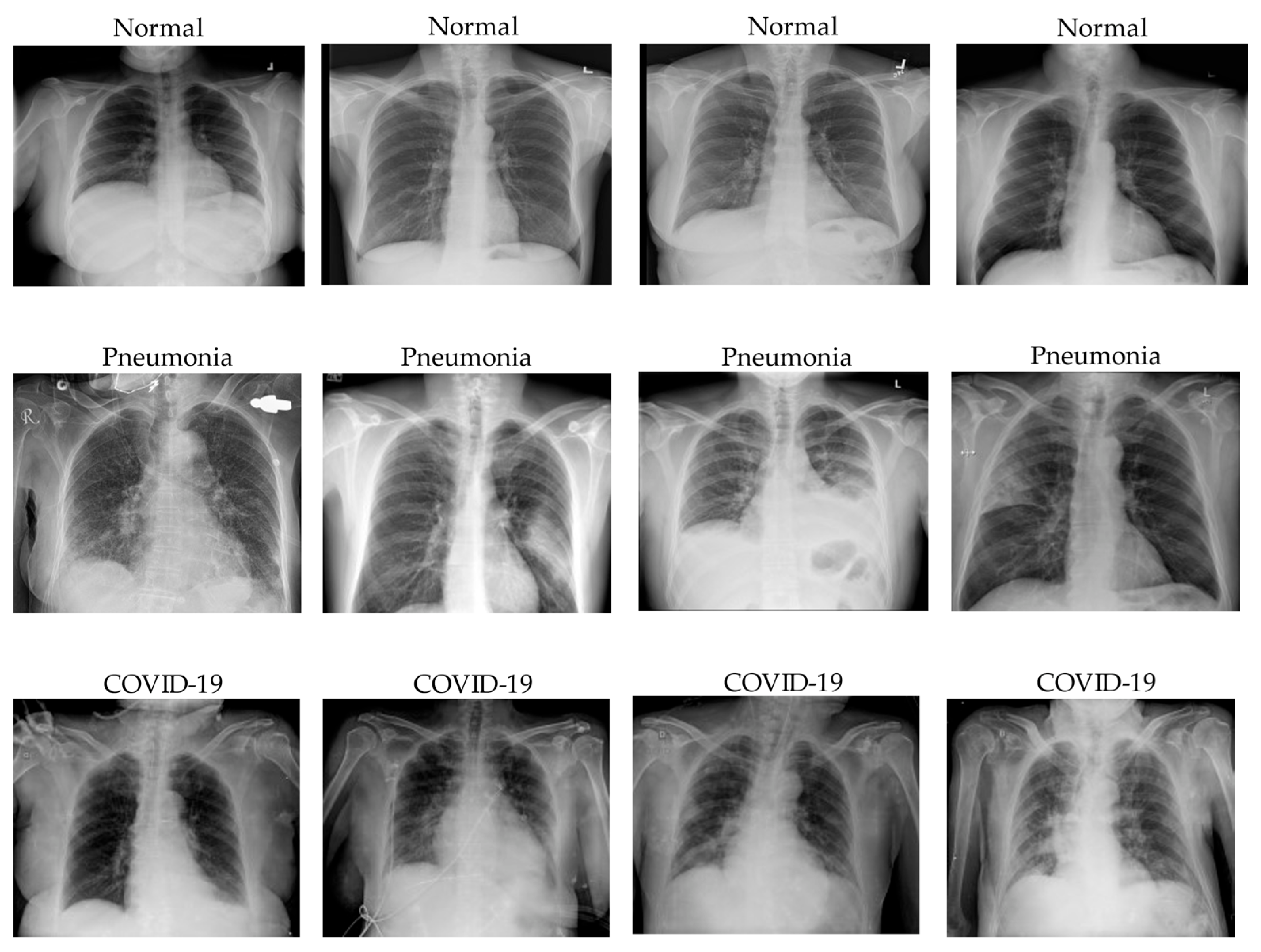 normal chest x ray images