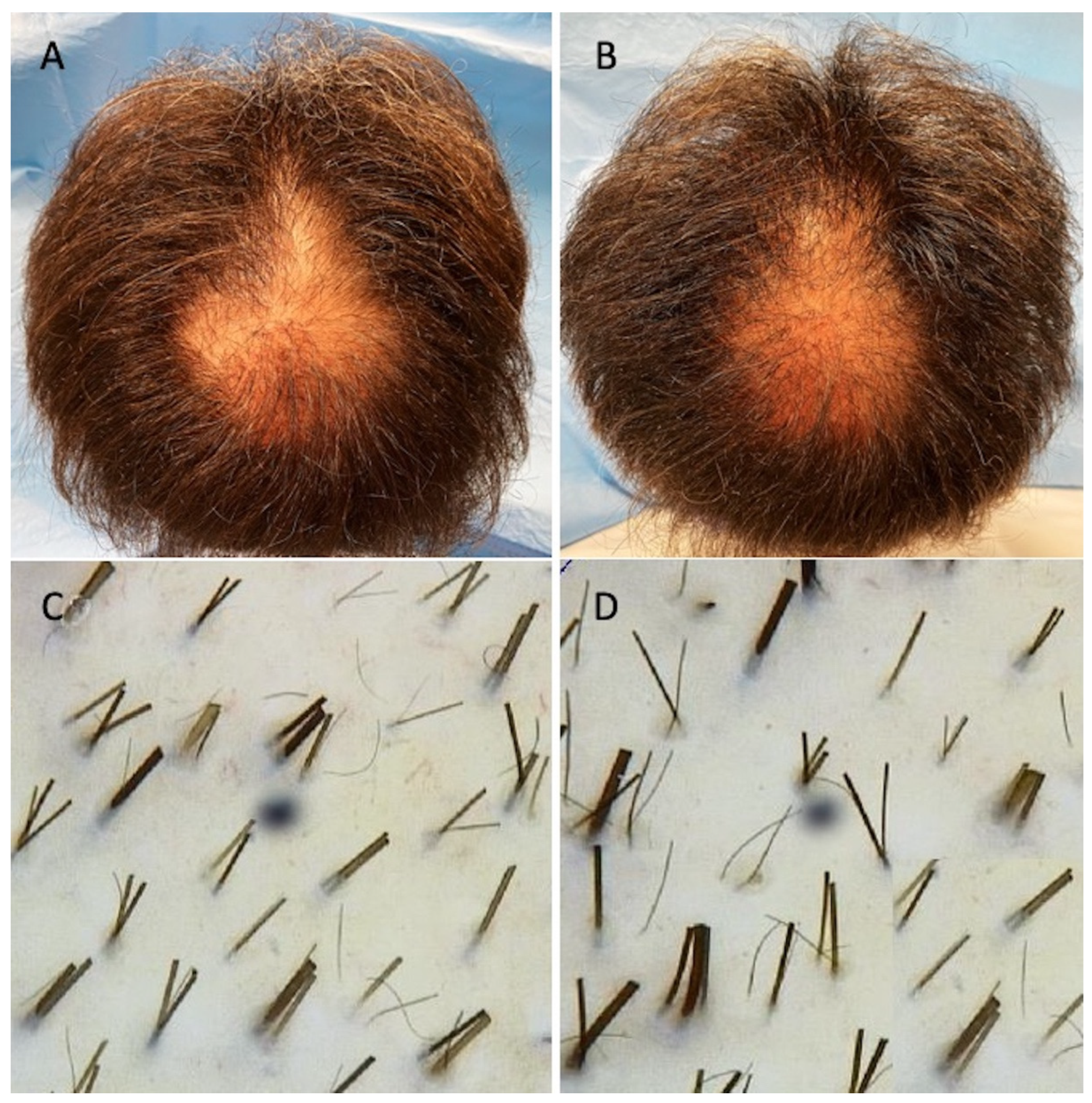 Applied Sciences | Free Full-Text | Hair Growth Booster Effects of  Micro-Needling with Low-Level Led Therapy and Growth Factors on Subjects  Treated with Finasteride®