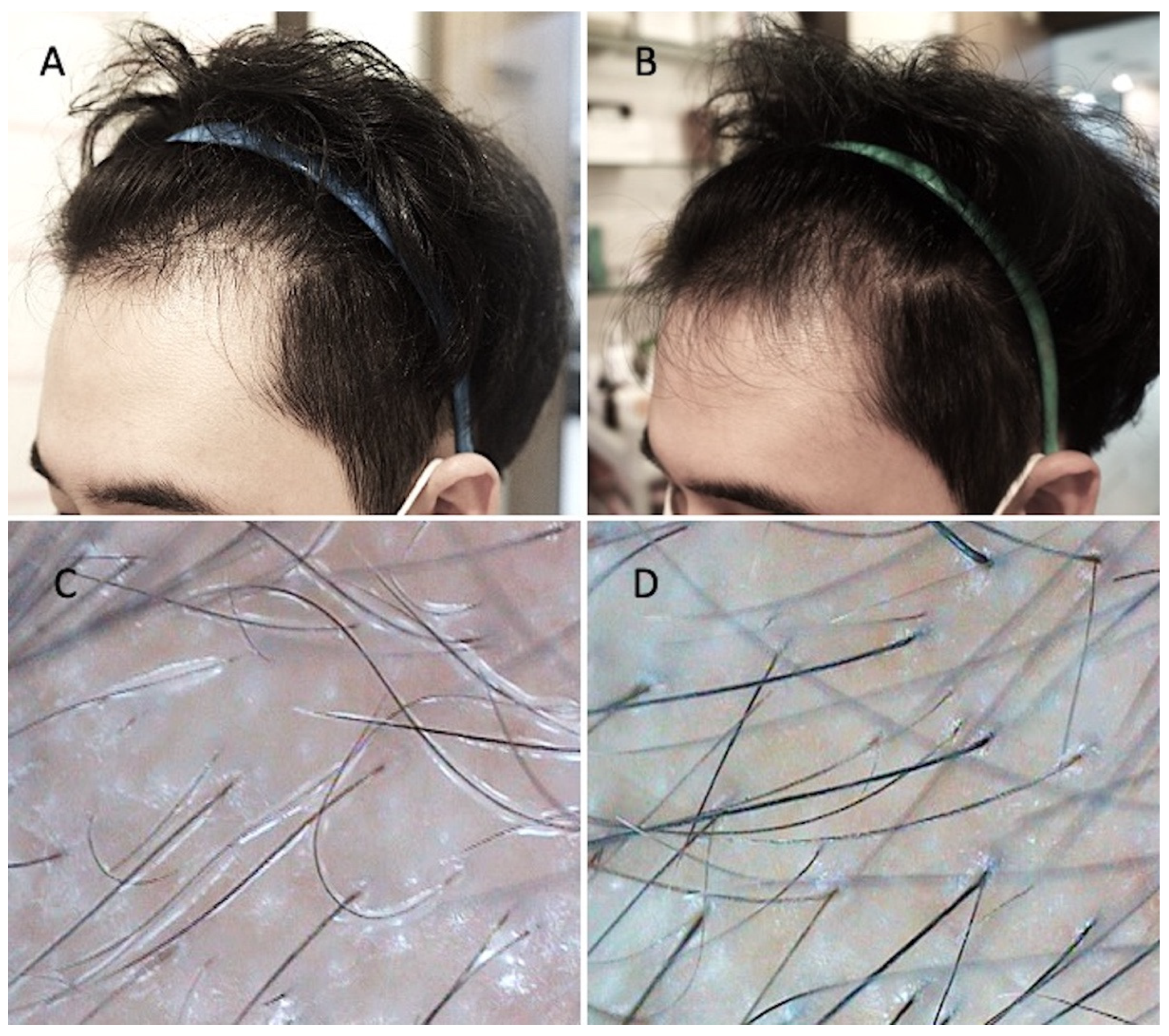Applied Sciences | Free Full-Text | Hair Growth Booster Effects of  Micro-Needling with Low-Level Led Therapy and Growth Factors on Subjects  Treated with Finasteride®