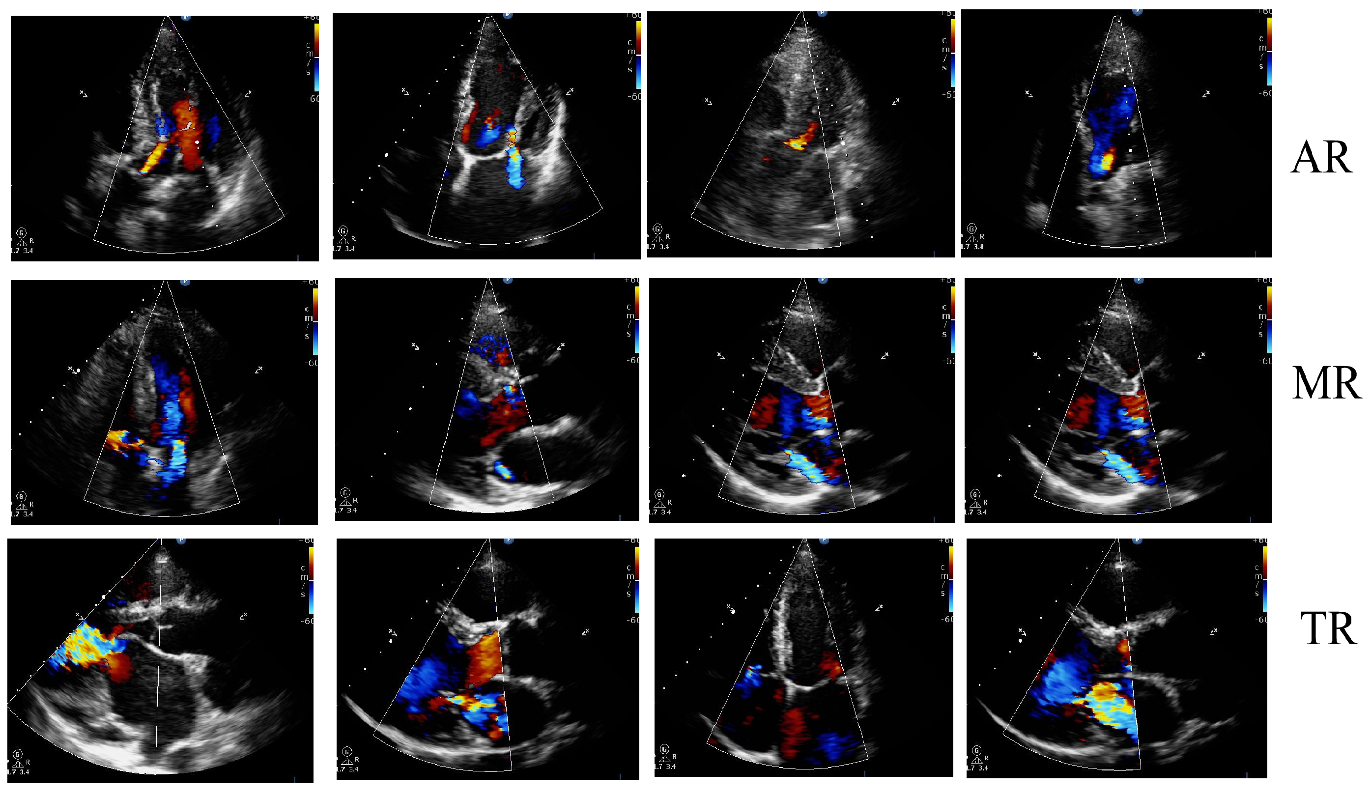 Classification Of Valvular Regurgitation Using Echocardiography Classification Of Valvular Regurgitation Using Echocardiography