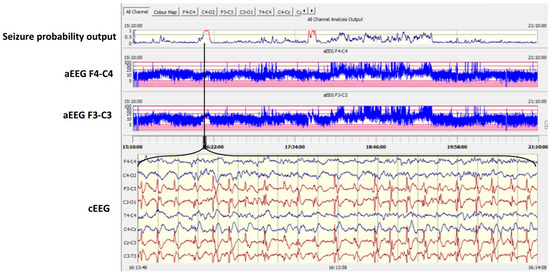 Applications of Artificial Intelligence in Neonatology
