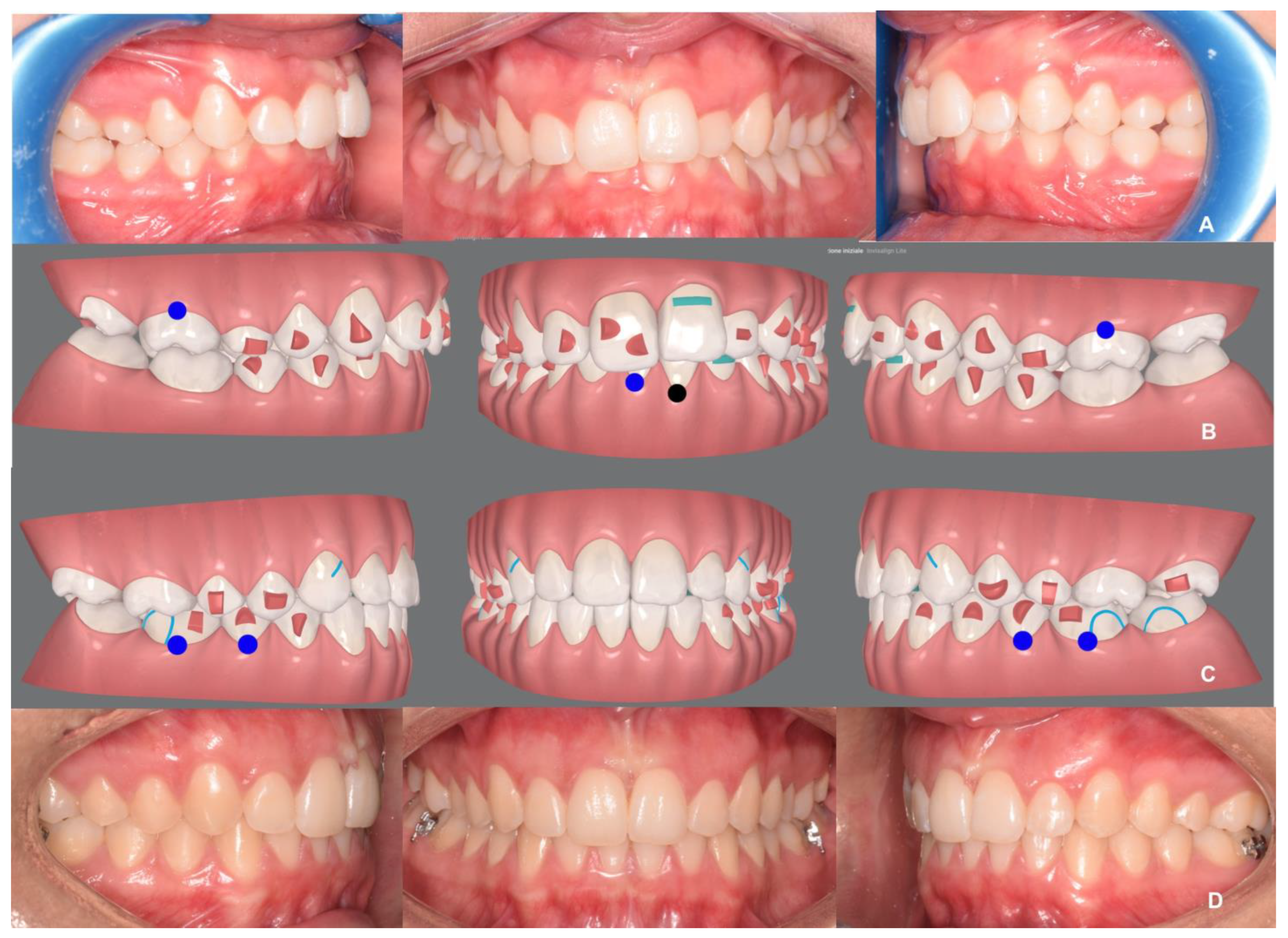 Invisalign invisible orthodontics in Paris- Dental alignment