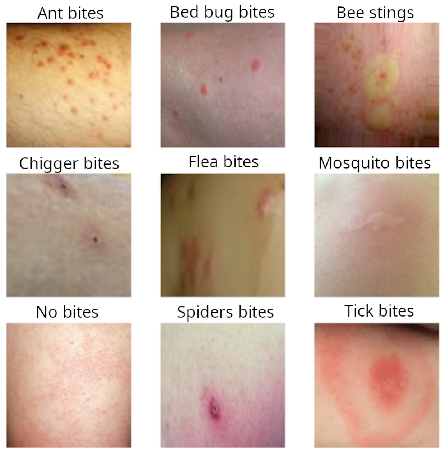 Deep Learning Methods For Bug Bite Classification An End to End System Deep Learning Methods For Bug Bite Classification An End to End System