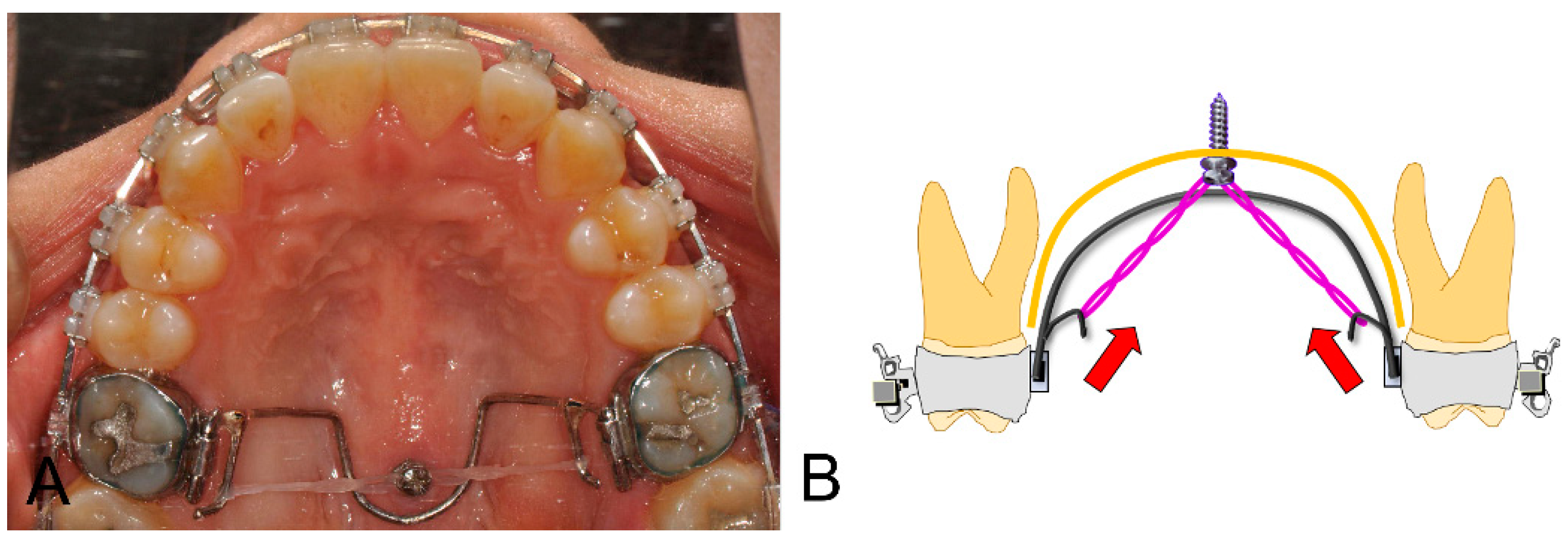 Applied Sciences | Free Full-Text | Open-Bite Correction Using a Mid-Palatal  TAD with an Intrusion TPA: Anteroposterior Position of TAD