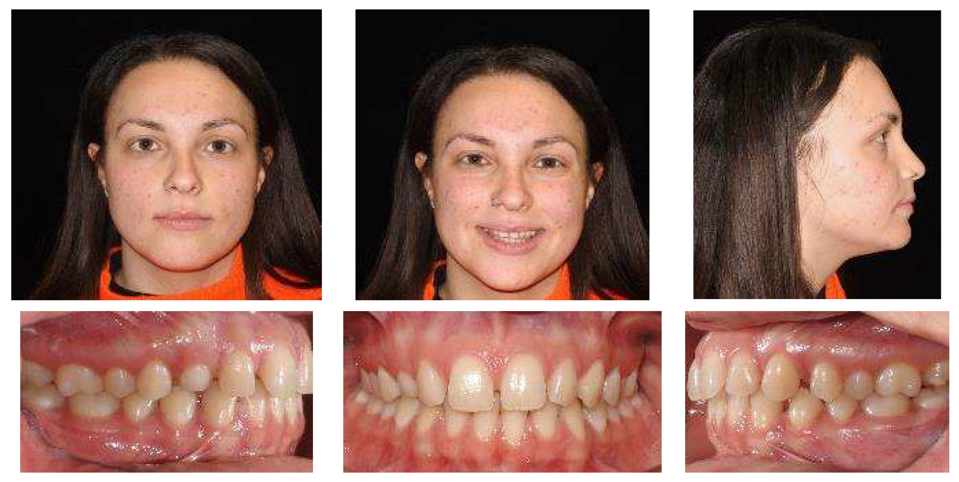 Types of Braces, Amato Orthodontics