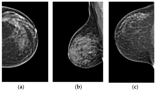 Sternal lesion depicted on screening breast MR images in a 34-year-old