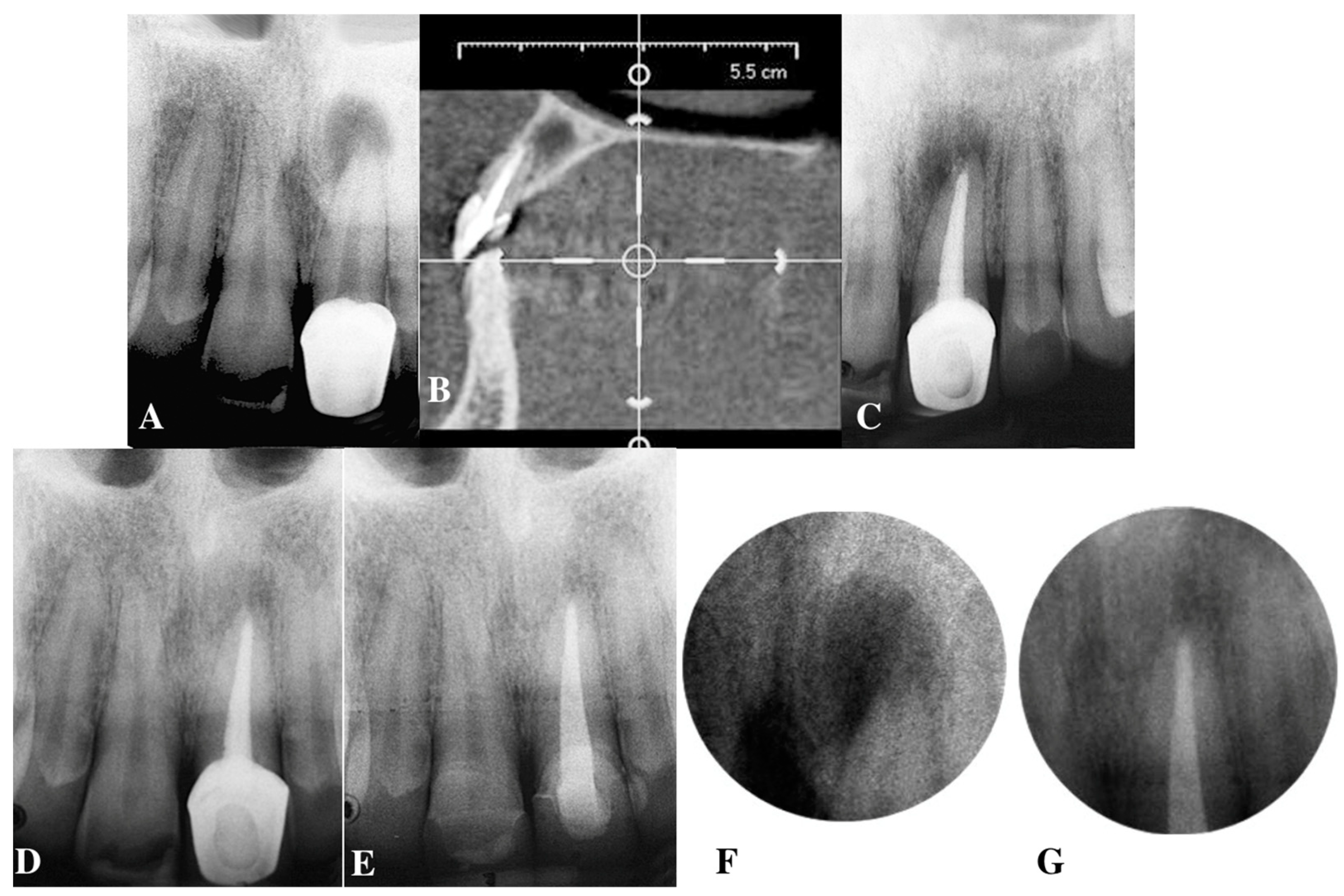 A) Preoperative periapical radiograph of tooth #21. Note the