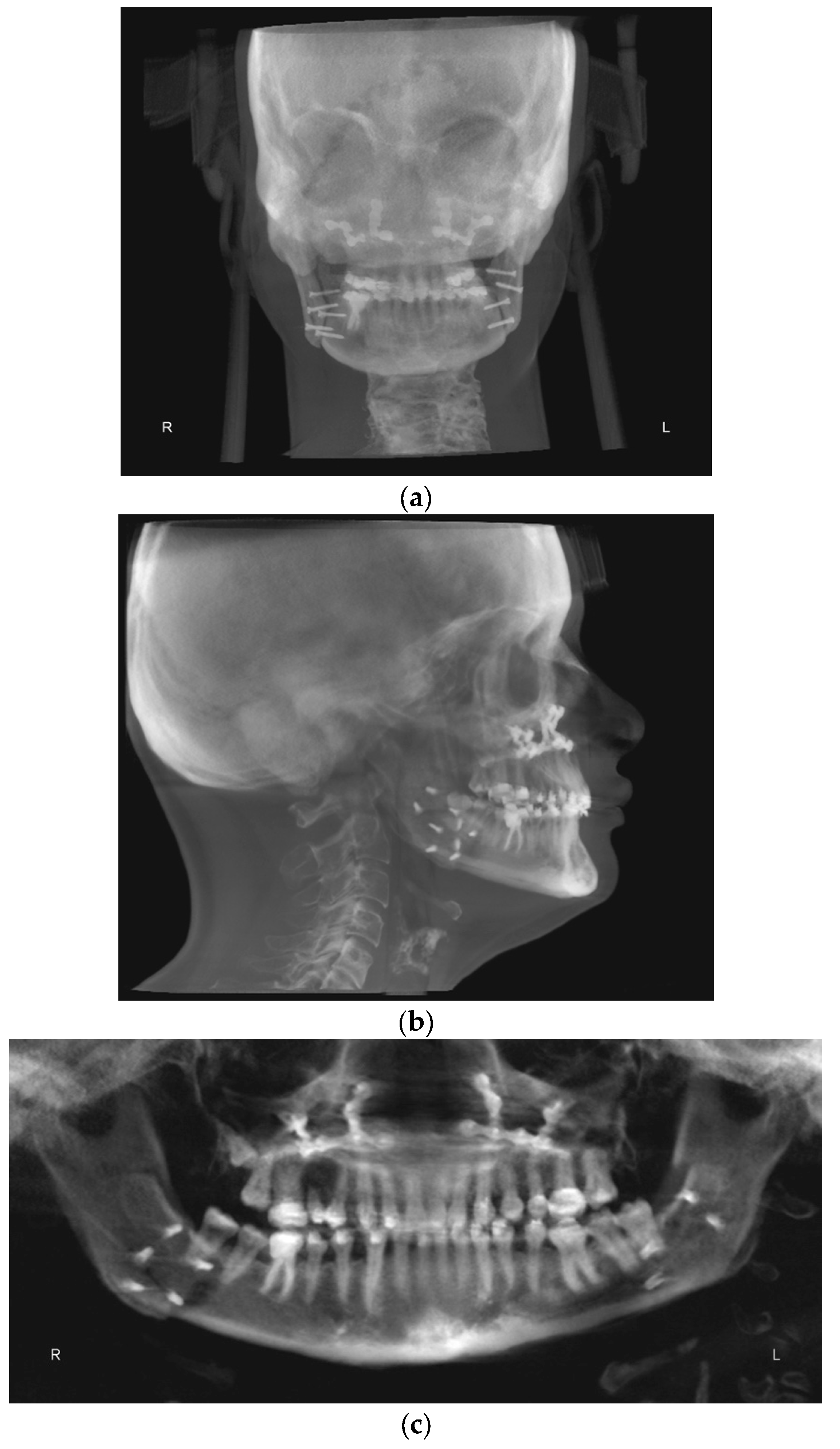 Treatment of Orthognathic Surgical Class III Patient with Coffin–Siris ...