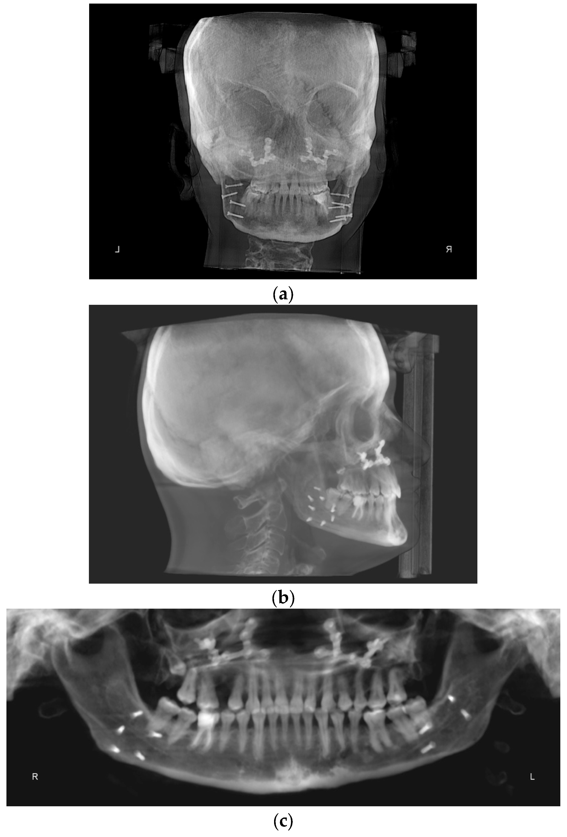 Treatment of Orthognathic Surgical Class III Patient with Coffin–Siris ...