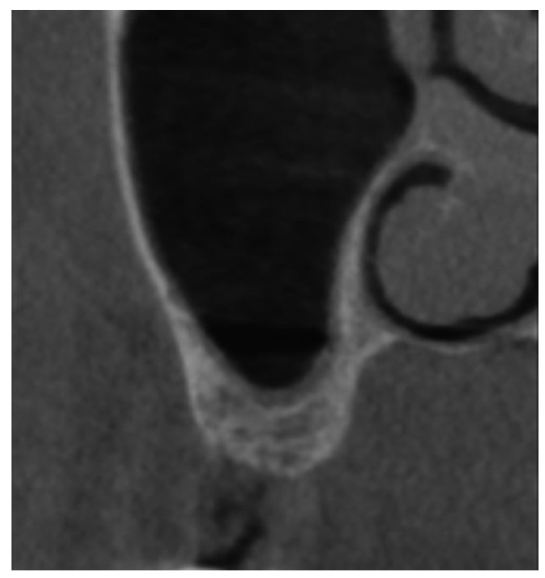 Applied Sciences | Free Full-Text | Crestal Sinus Lift with the ...