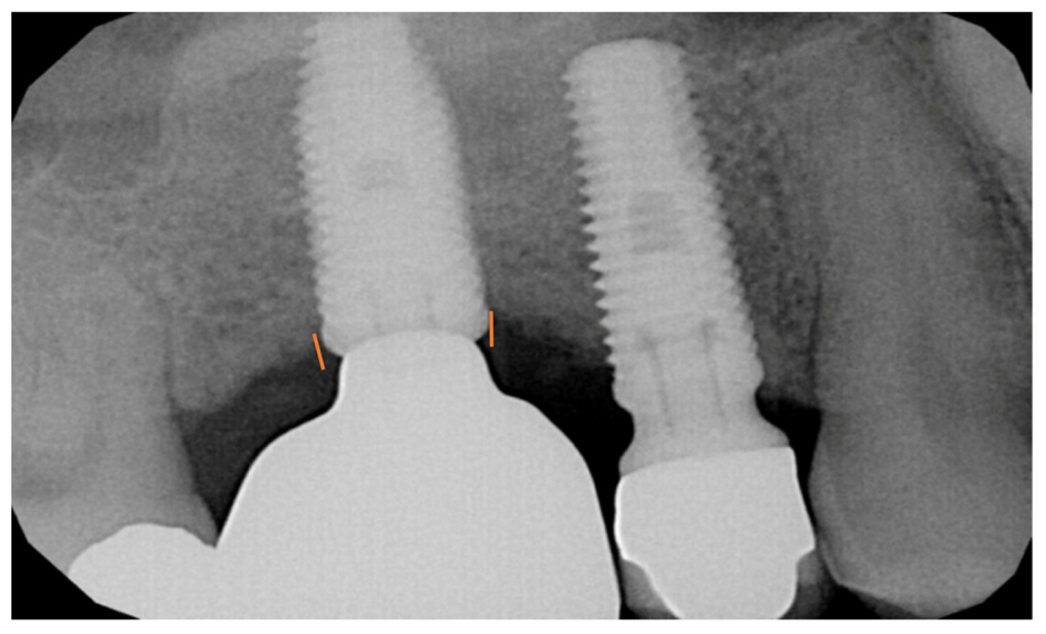 Applied Sciences | Free Full-Text | Crestal Sinus Lift with the ...