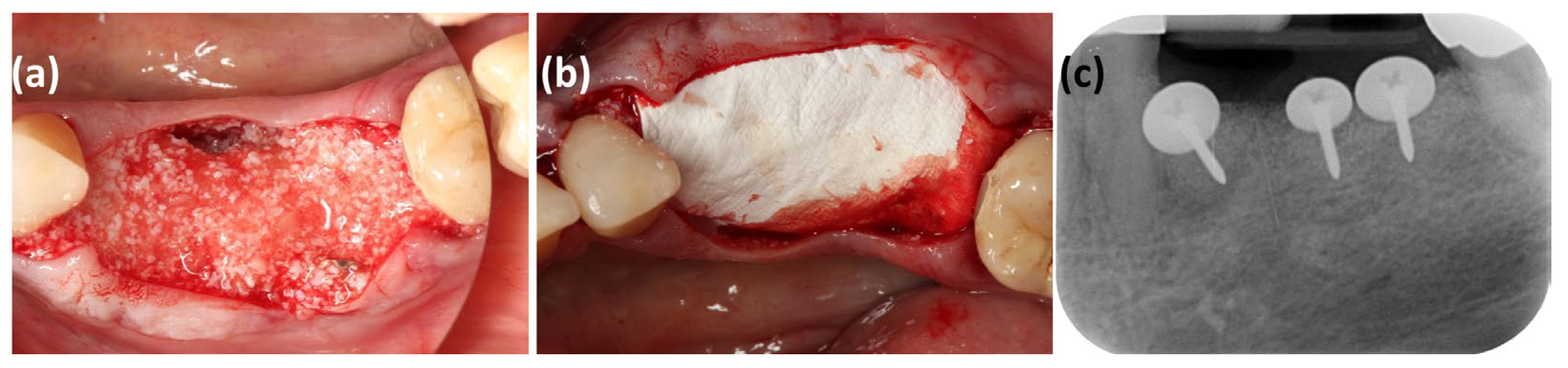 A Histological Assessment of Bone Augmentation of a Knife-Edge Alveolar ...
