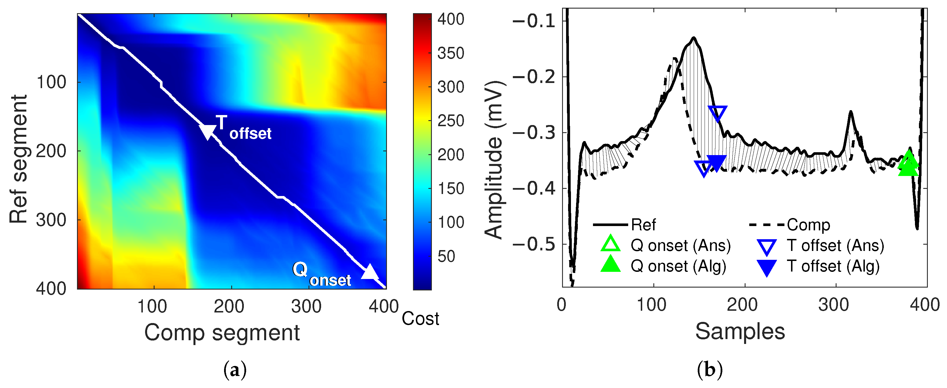 Correlation Based Dynamic Time Warping for ECG Waveform