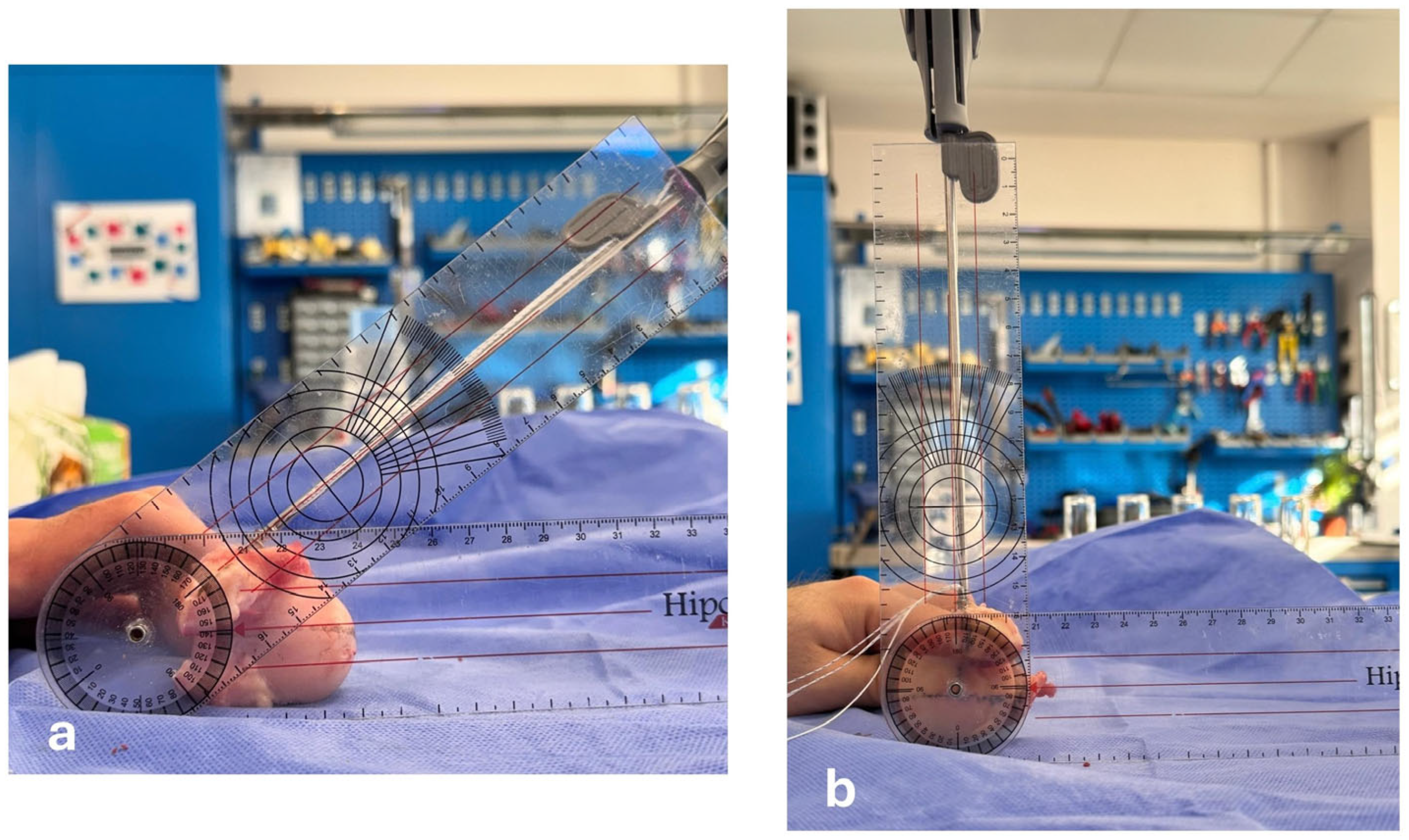 Comparison of 45° and 90° Medial Row Anchor Insertion Angles in Double ...