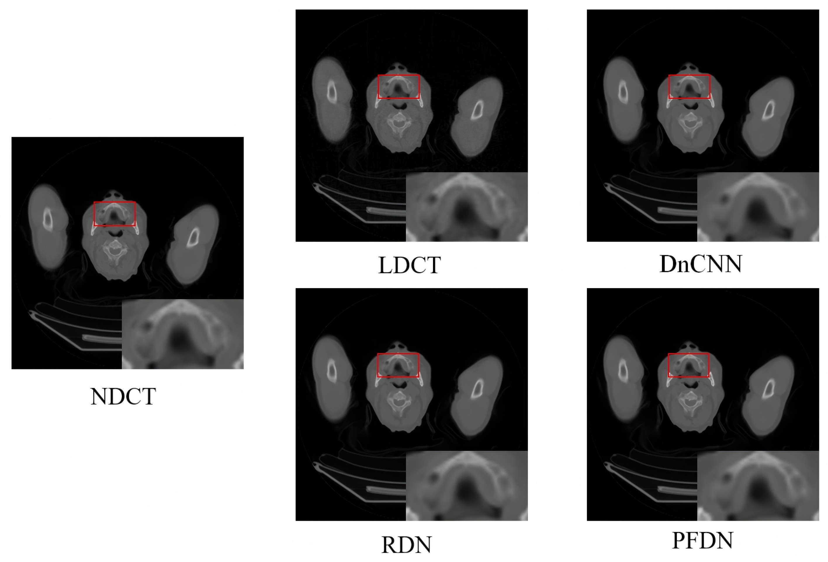 Low-Dose CT Image Denoising Based on a Progressive Fusion Distillation ...