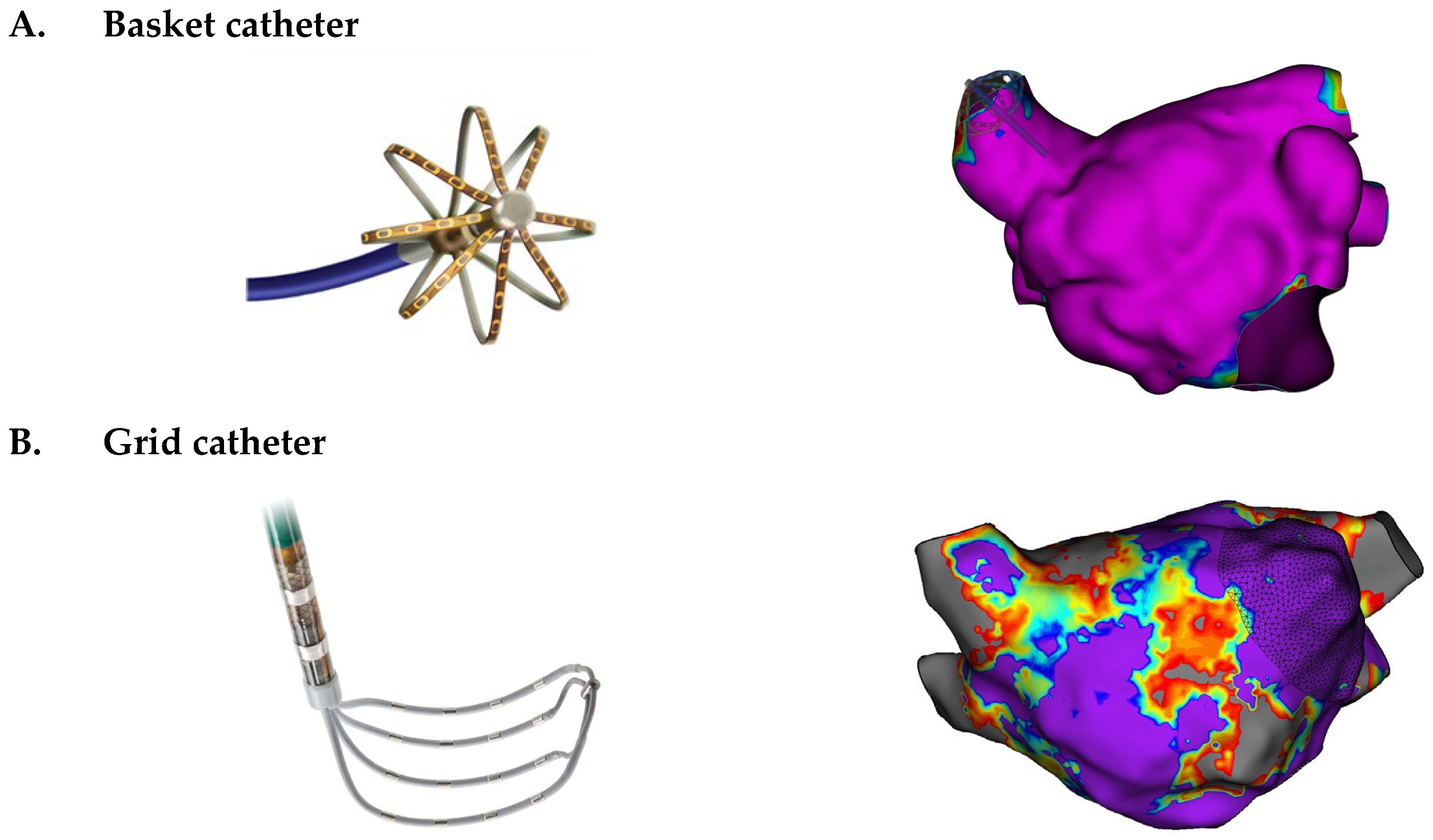 Pentary Workflow Efficiency of High-Density Left Atrial Mapping: A Real-World ...