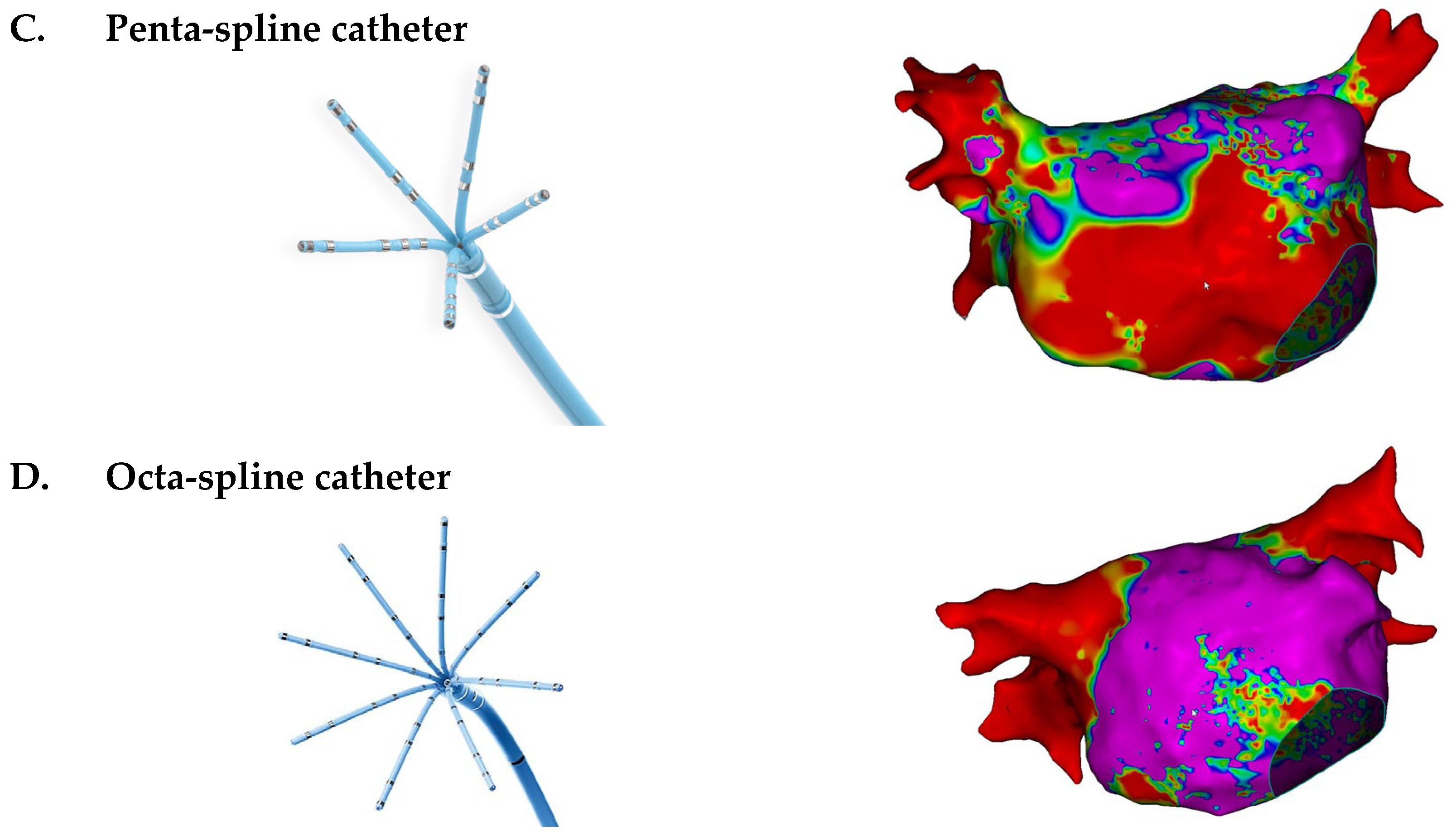Pentary Workflow Efficiency of High-Density Left Atrial Mapping: A Real-World ...