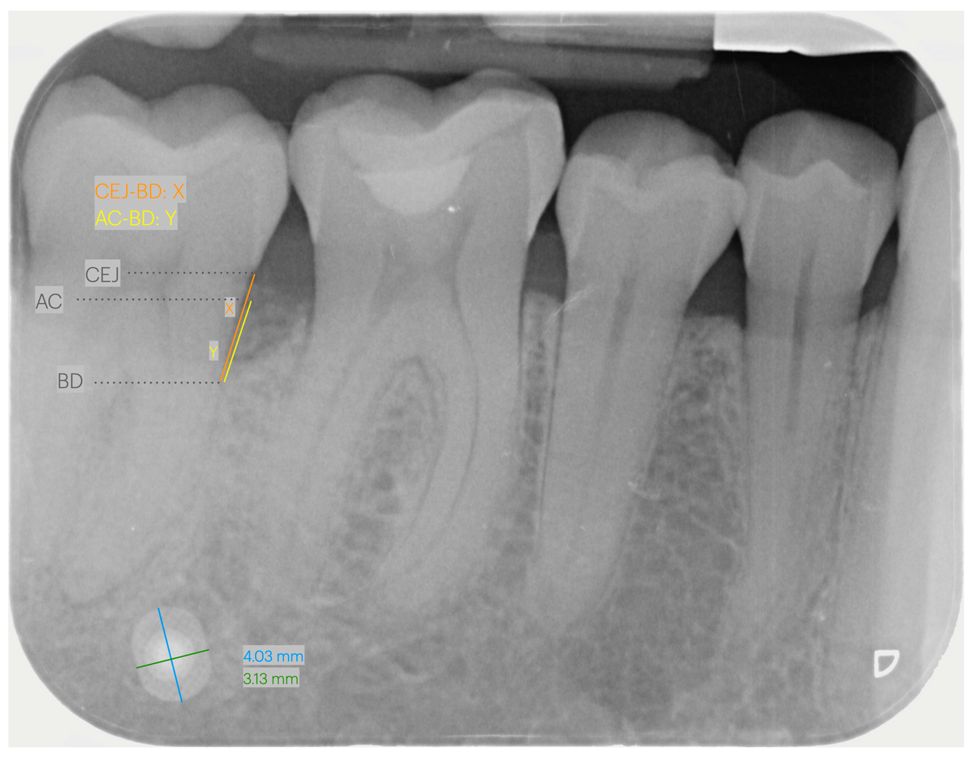 Normal Bone Level Radiograph Evaluation of Bone Level Using Periapical Radiography and CBCT: A ...