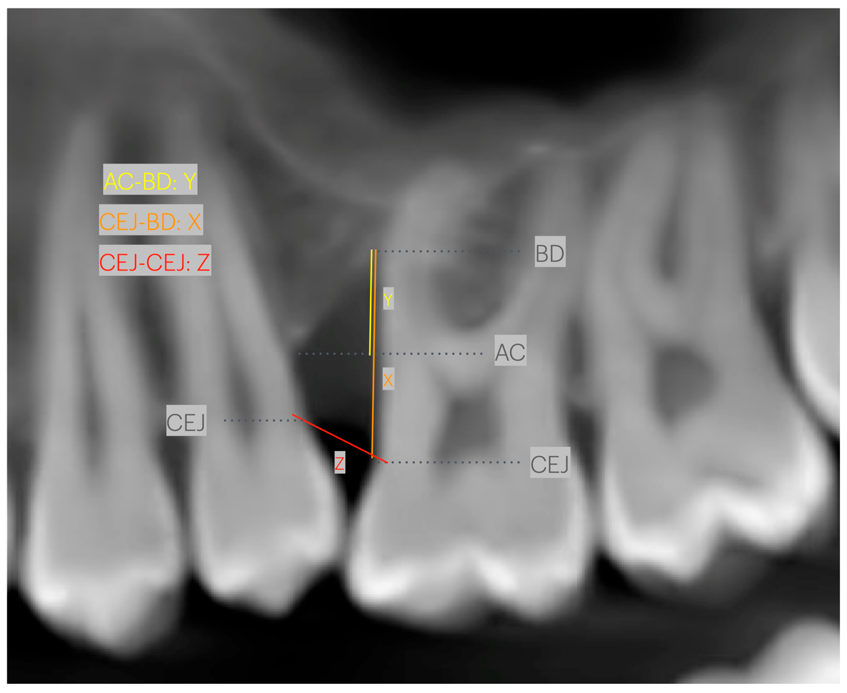 Normal Bone Level Radiograph Evaluation of Bone Level Using Periapical Radiography and CBCT: A ...